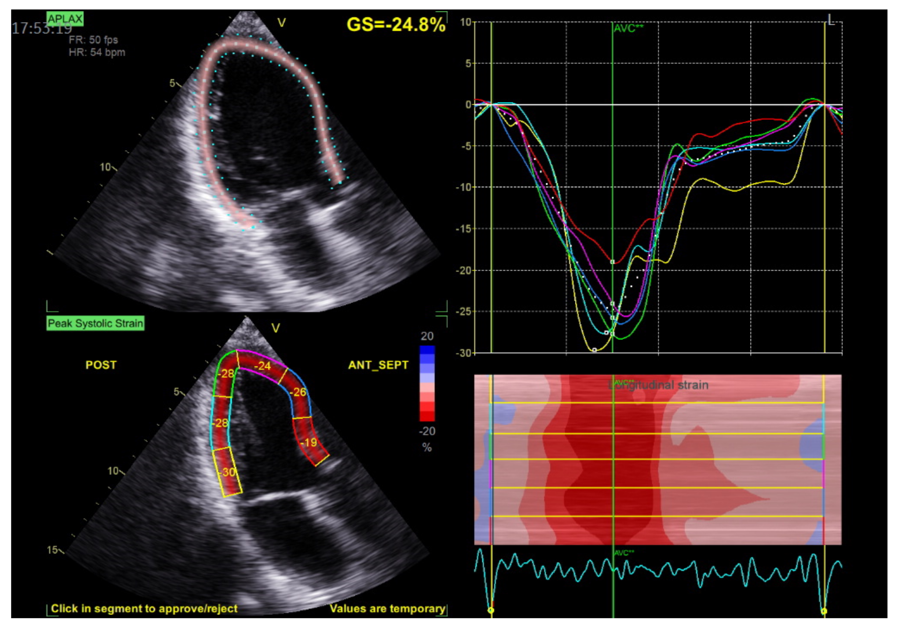 Regional Variability in Longitudinal Strain Across Vendors in Patients With  Cardiomyopathy Due to Increased Left Ventricular Wall Thickness