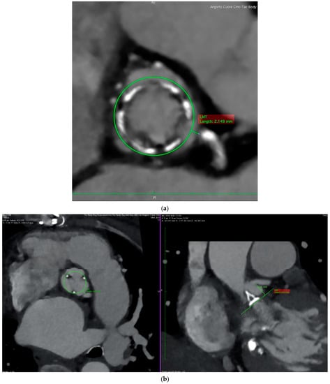 JCDD | Free Full-Text | Coronary Obstruction During Valve-in-Valve ...