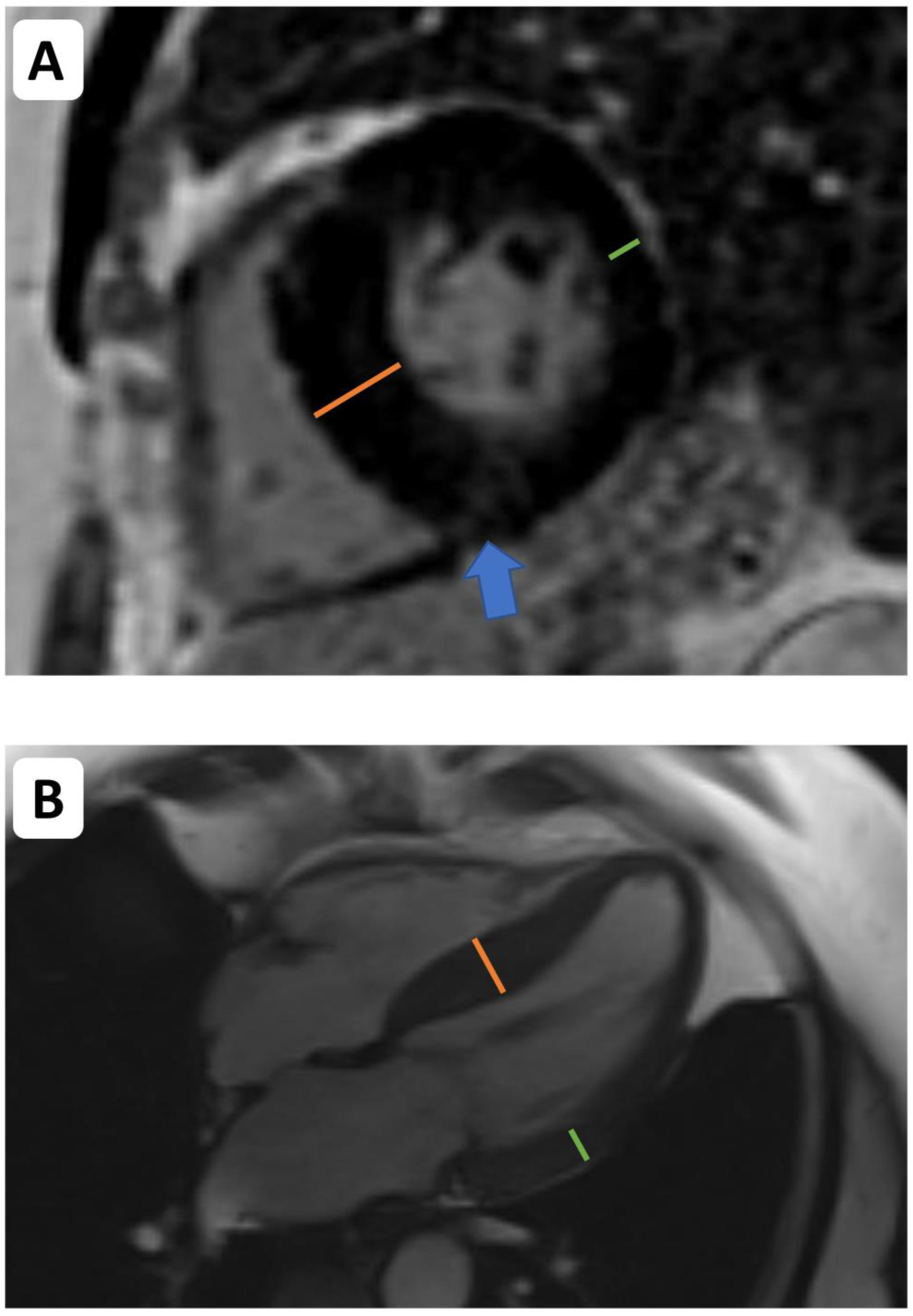 Global Longitudinal Strain Analysis Using Cardiac MRI in Aortic Stenosis:  Comparison with Left Ventricular Remodeling, Myocardial Fibrosis, and  2-year Clinical Outcomes