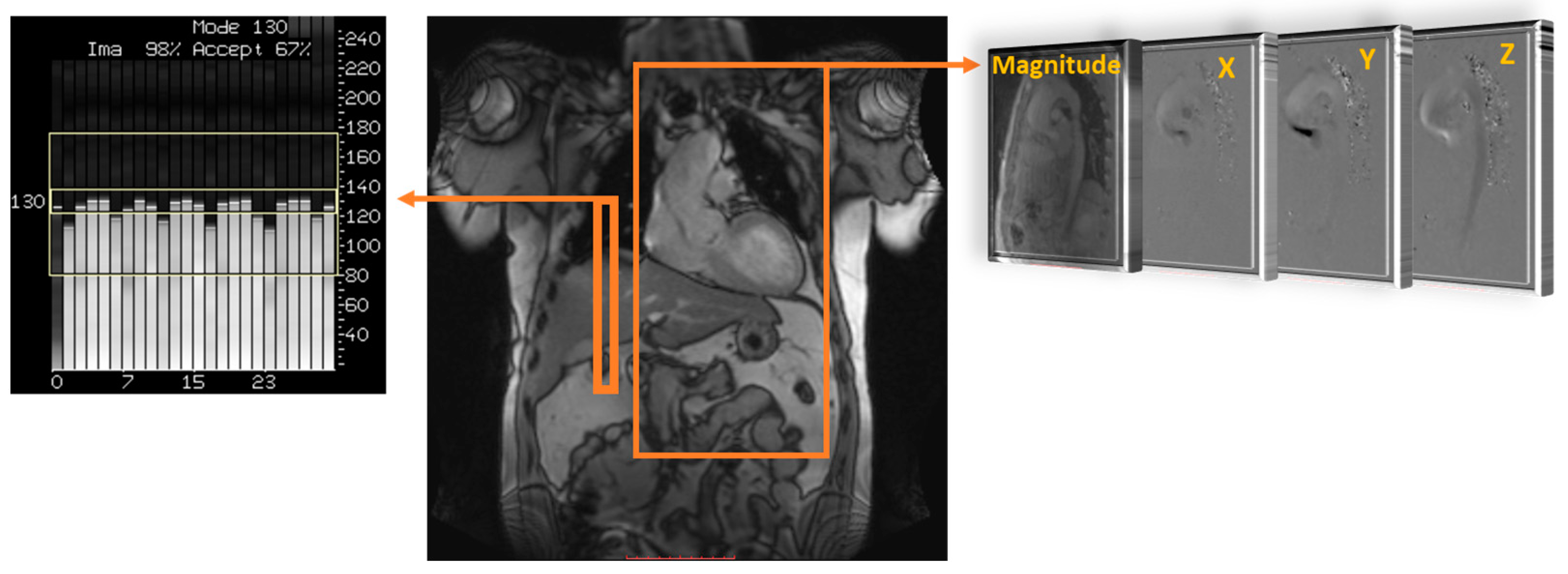 Reproducibility of 4D cardiac computed tomography feature tracking