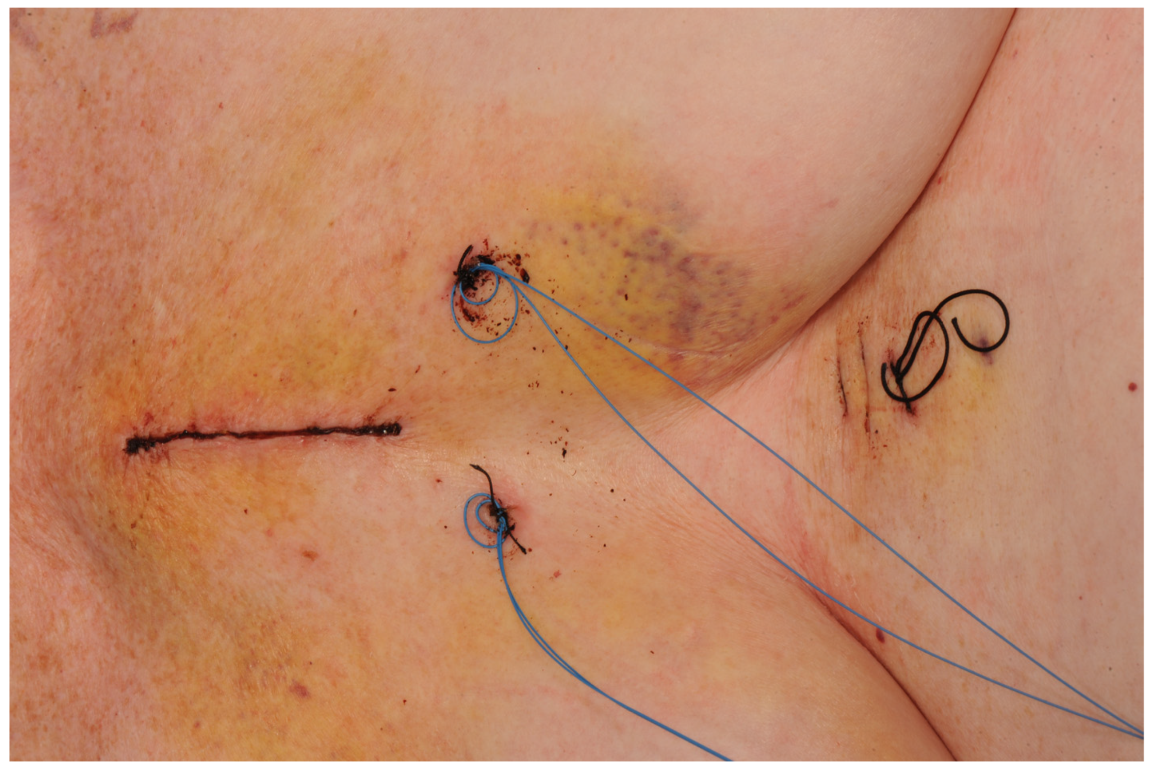 131 Types and Causes of Post Dermatologic Surgery Complications and  Possible Solutions I  DPS