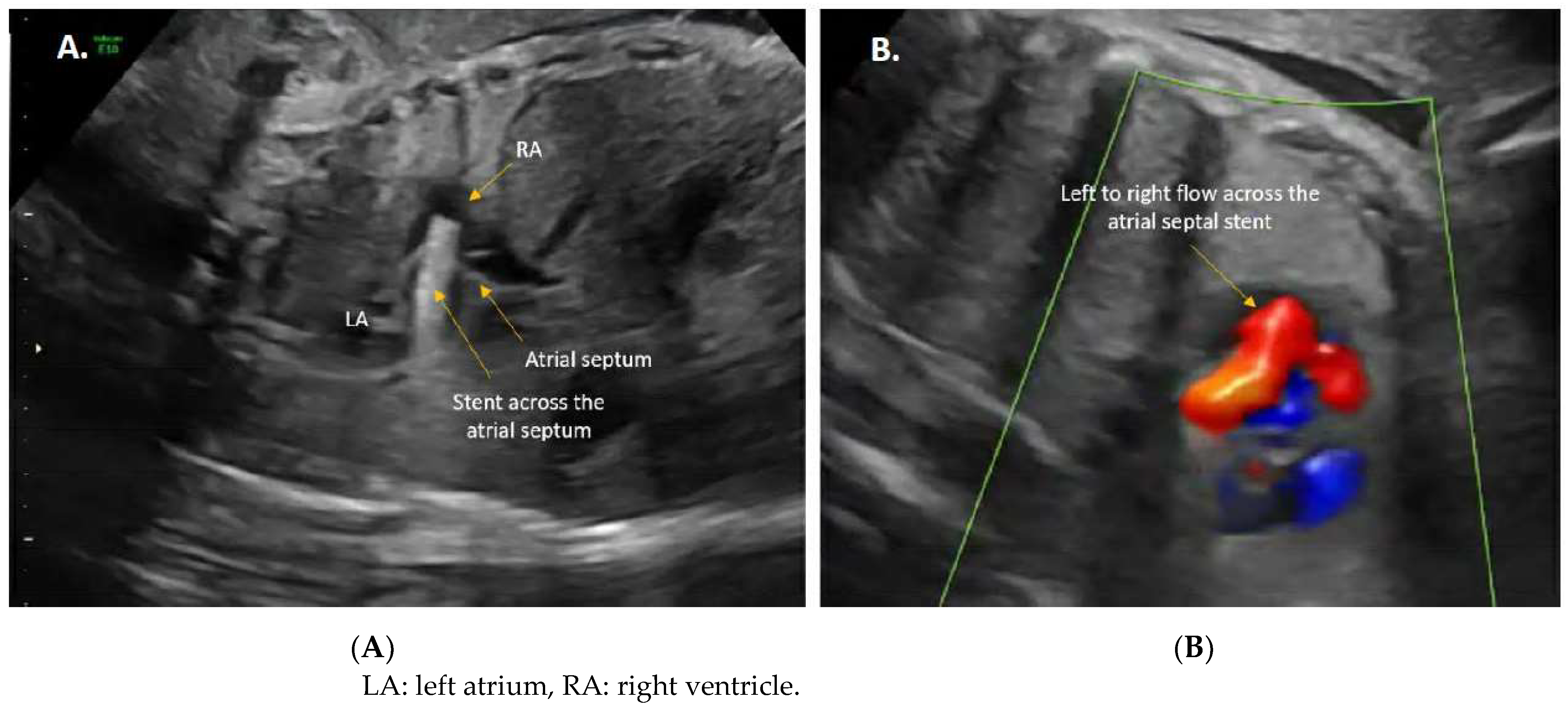 Catheter-Based Fetal Cardiac Interventions