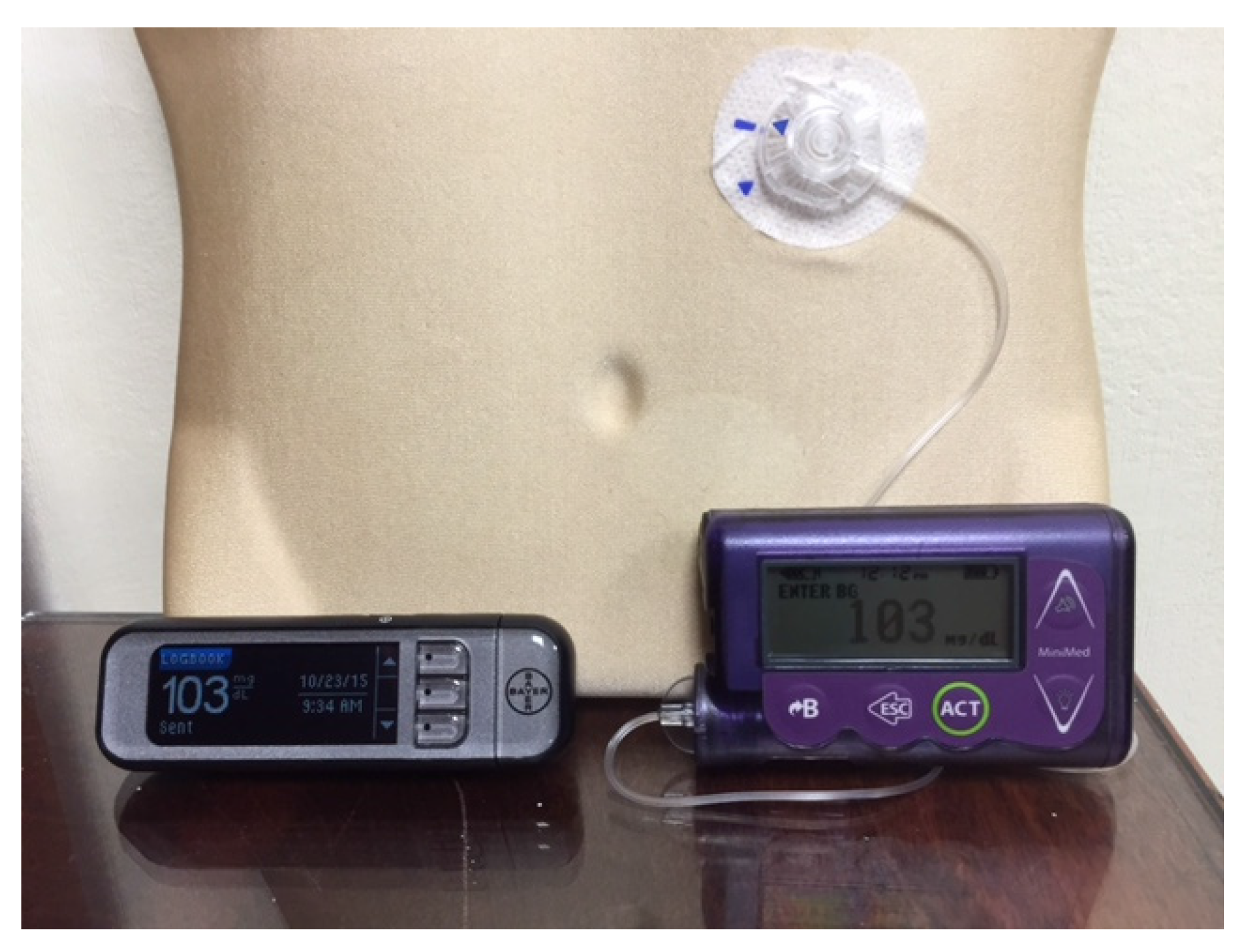 JCM | Free Full-Text | An Overview of Insulin Pumps and Glucose Sensors for  the Generalist