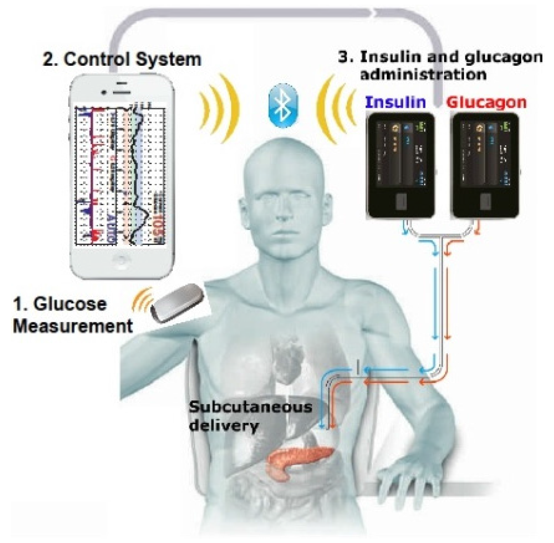 JCM | Free Full-Text | An Overview of Insulin Pumps and Glucose Sensors for  the Generalist | HTML