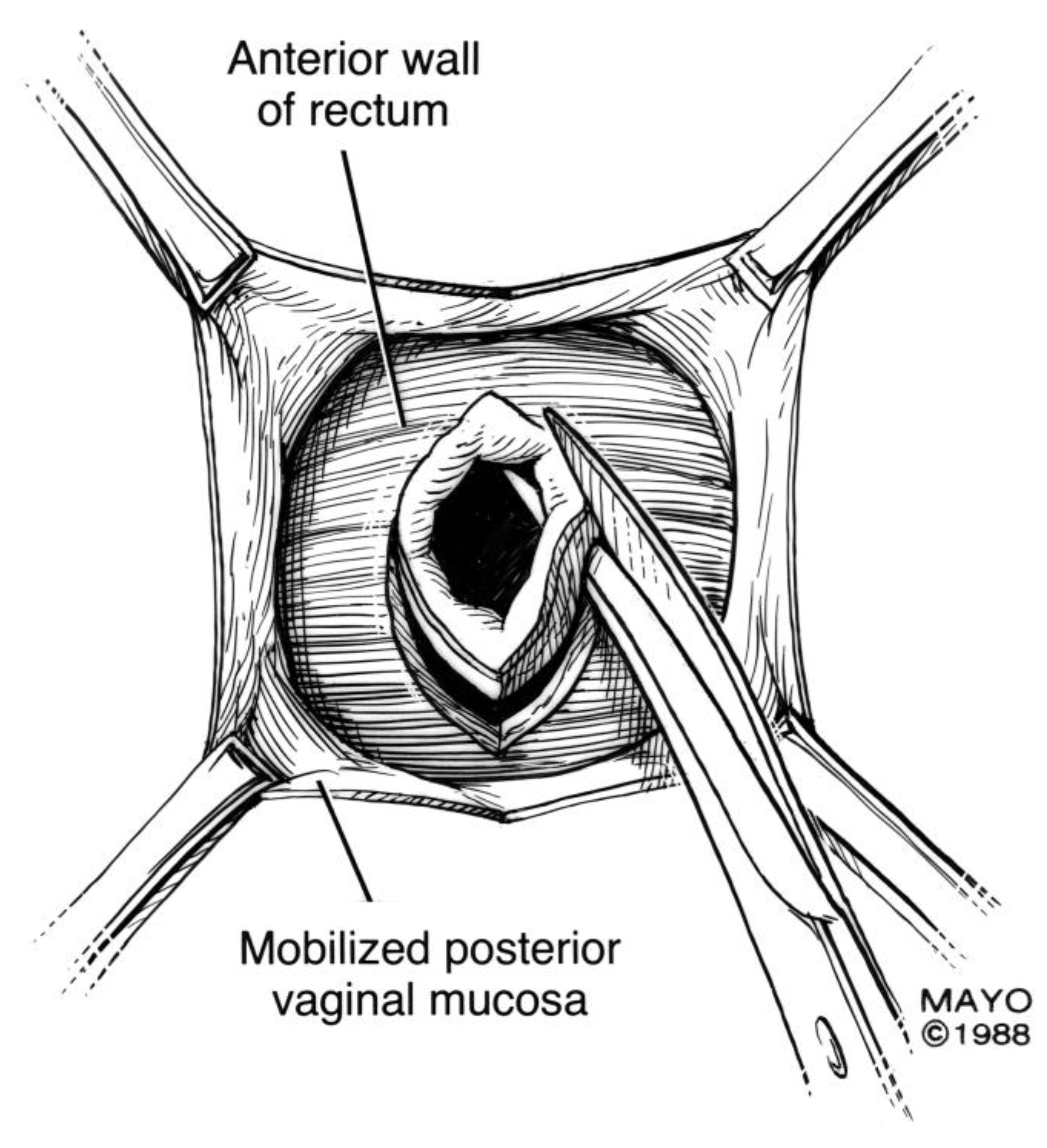 Rectovaginal Fistula Discharge