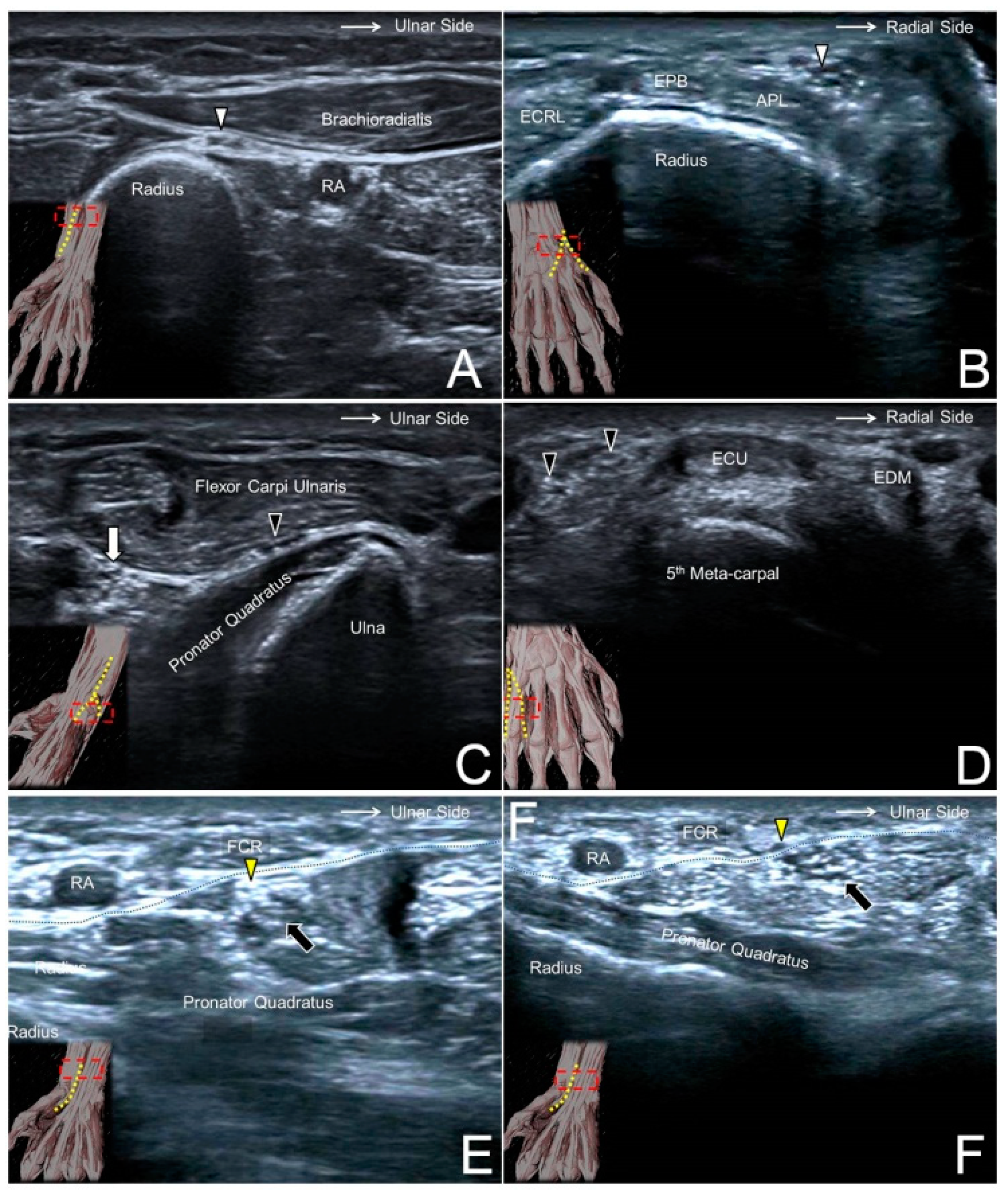 Ulnar Nerve Block Ultrasound