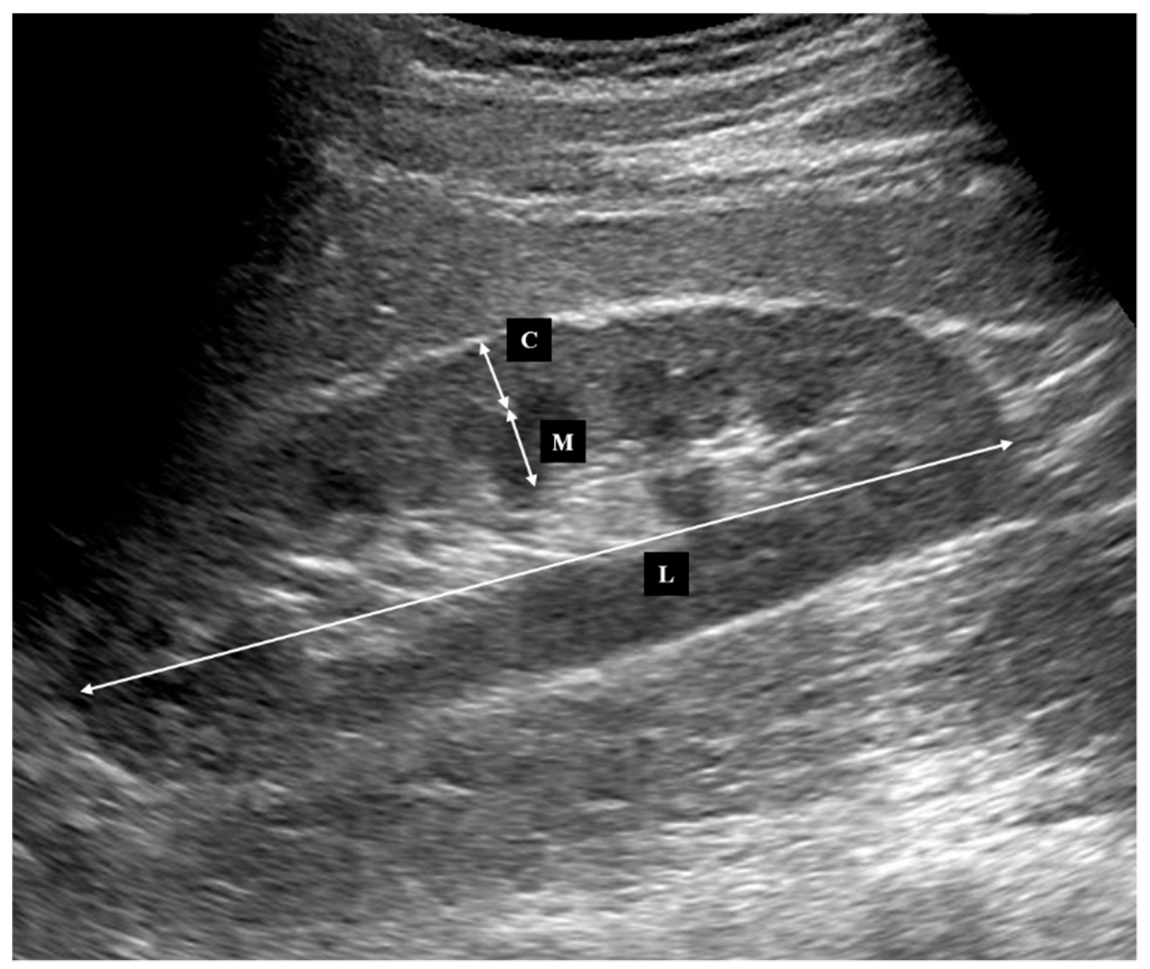 Jcm Free Full Text Predictive Value Of Cortical Thickness Measured By Ultrasonography For Renal Impairment A Longitudinal Study In Chronic Kidney Disease Html