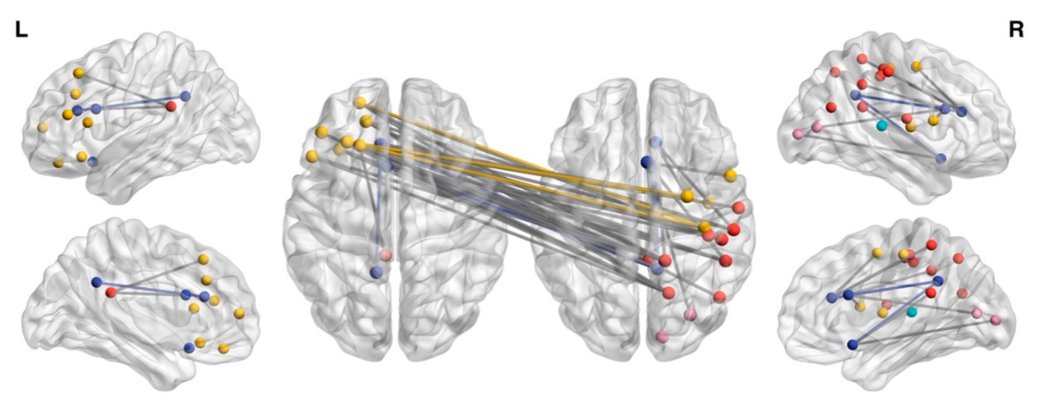 JCM | Free Full-Text | Functional Brain Network Topology Discriminates  between Patients with Minimally Conscious State and Unresponsive  Wakefulness Syndrome