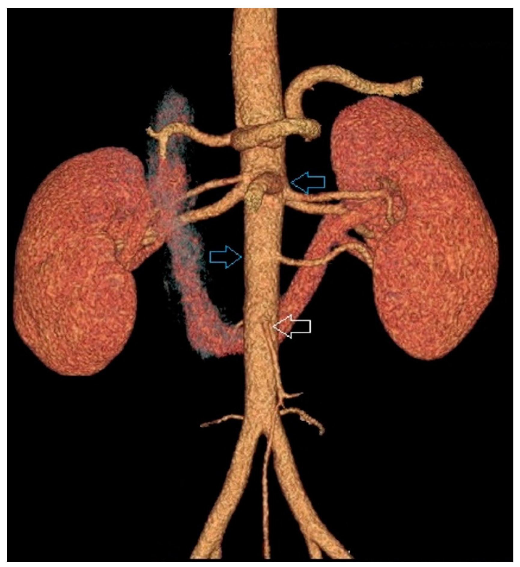 JCM | Free Full-Text | Diameters of Arteries Supplying Horseshoe Kidneys  and the Level They Branch off Their Parental Vessels: A CT-Angiographic  Study