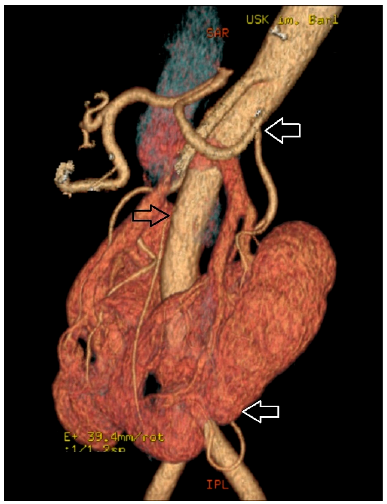 Understanding Horseshoe Kidney