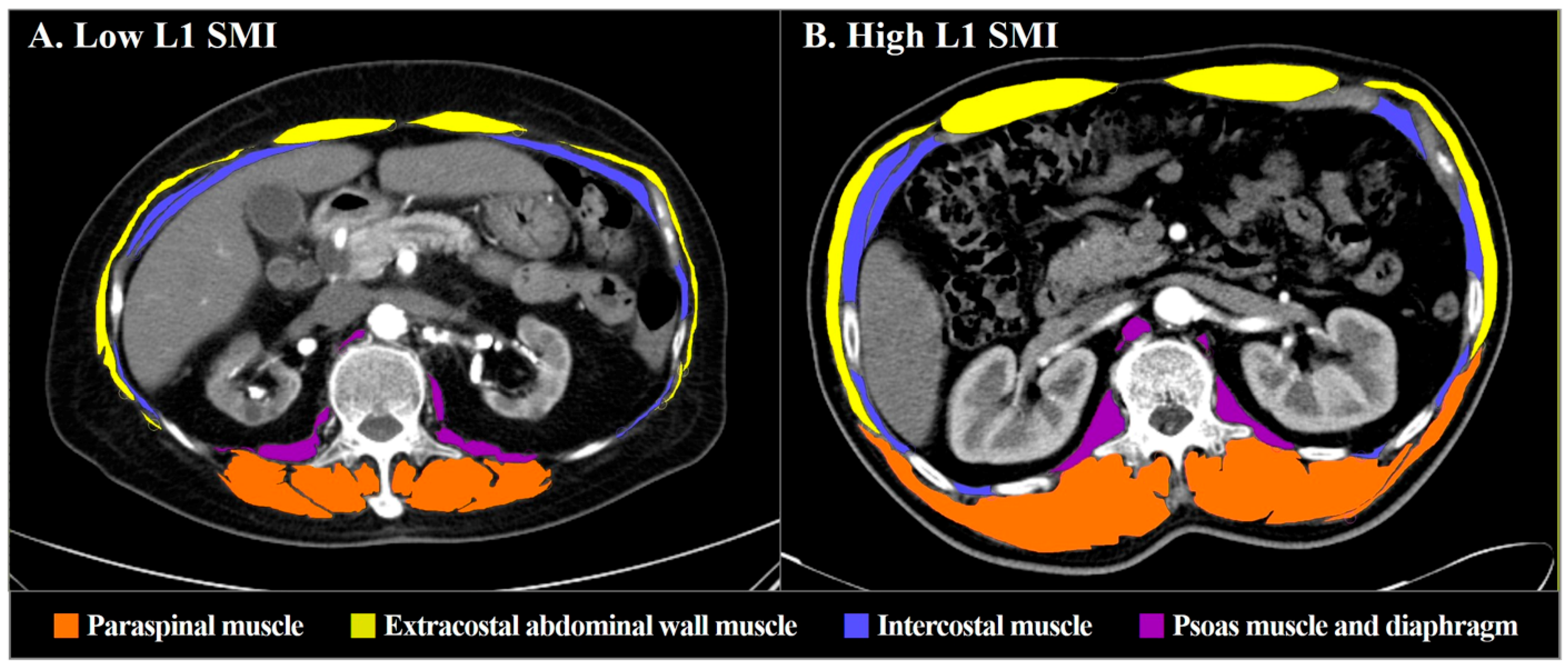 jcm-free-full-text-prognostic-impact-of-low-skeletal-muscle-mass-on