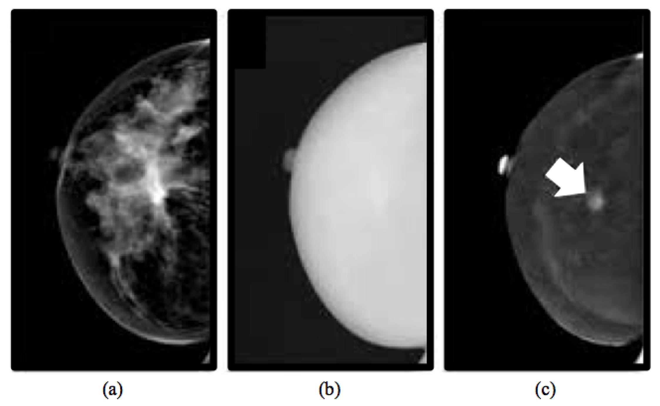 Case 4; Mammography of right breast lesions (pointed by arrows)