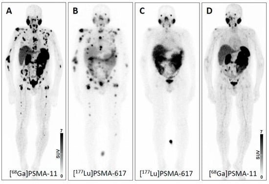 JCM | Free Full-Text | Recent Updates on Molecular Imaging Reporting and  Data Systems (MI-RADS) for Theranostic Radiotracers—Navigating Pitfalls of  SSTR- and PSMA-Targeted PET/CT