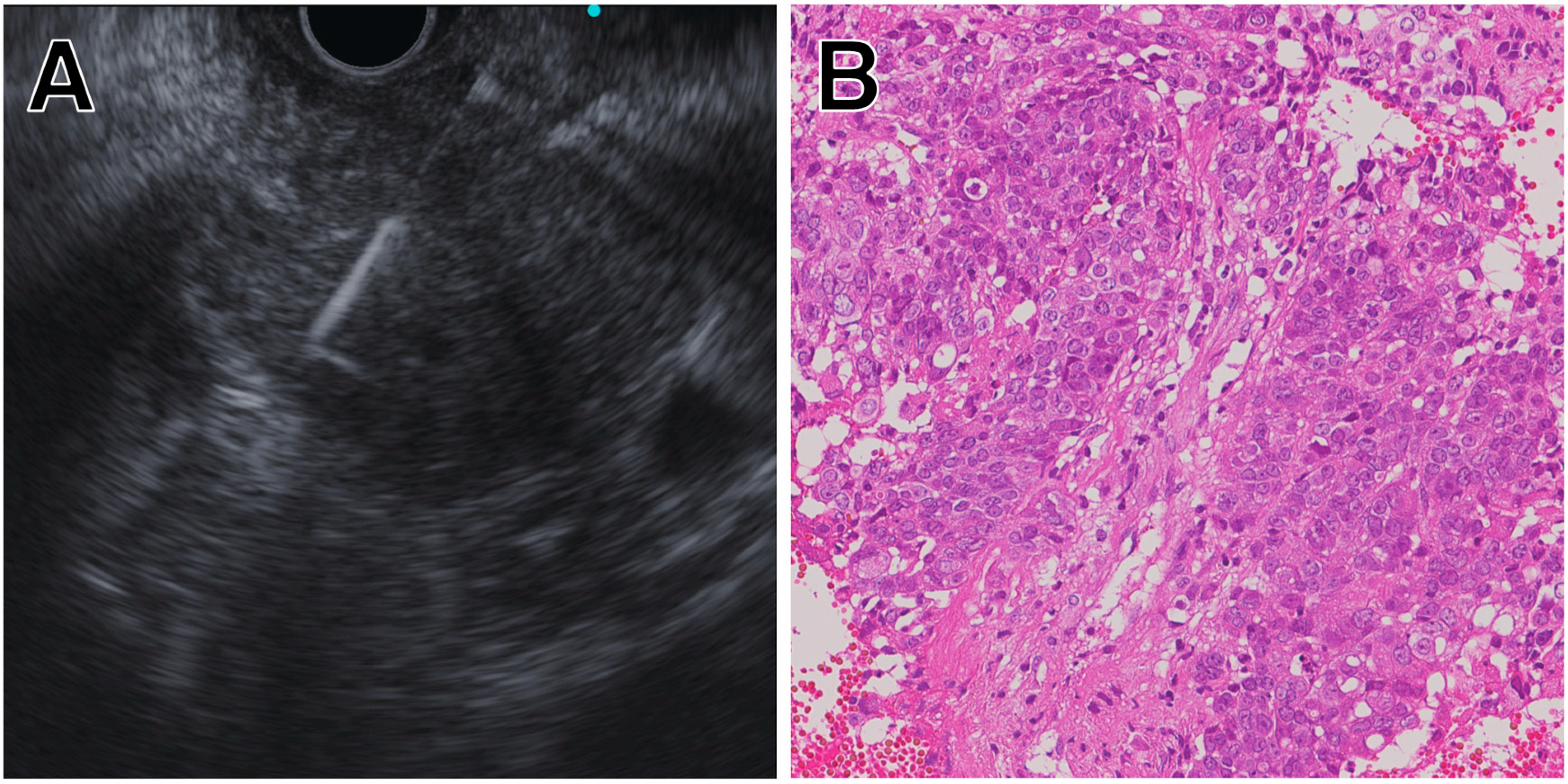 JCM | Free Full-Text | New Era Of Endoscopic Ultrasound-Guided Tissue ...