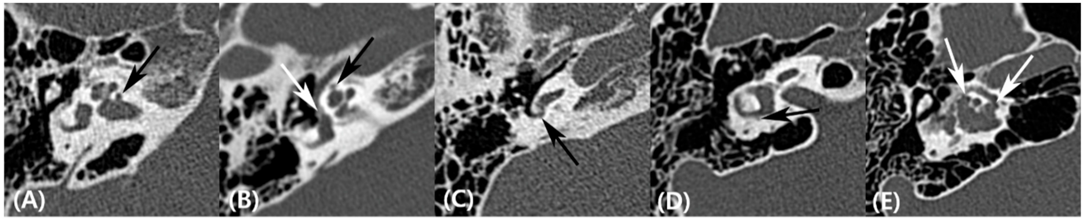 Frontiers  Audiovestibular Quantification in Rare Third Window