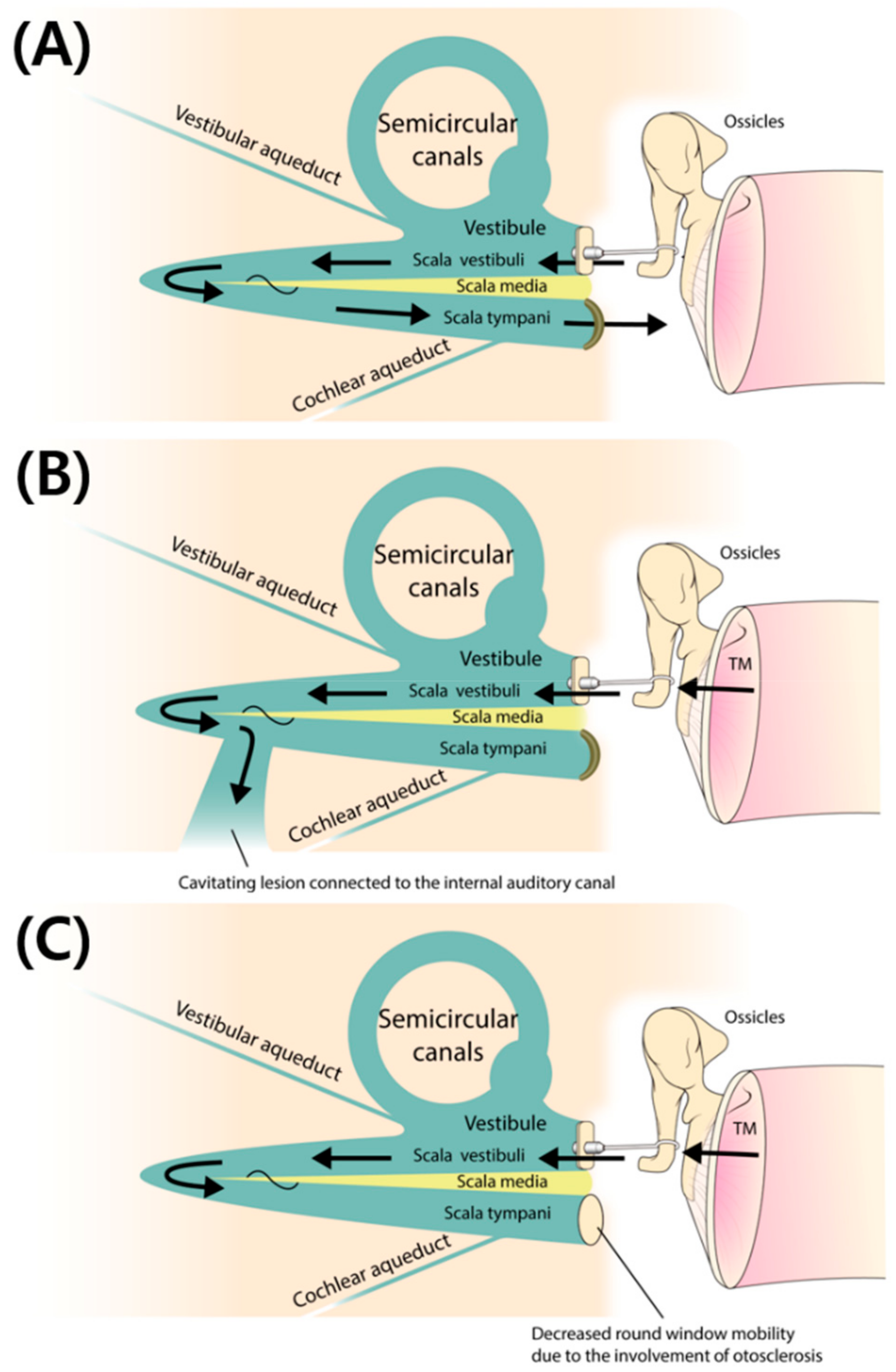 Frontiers  Audiovestibular Quantification in Rare Third Window