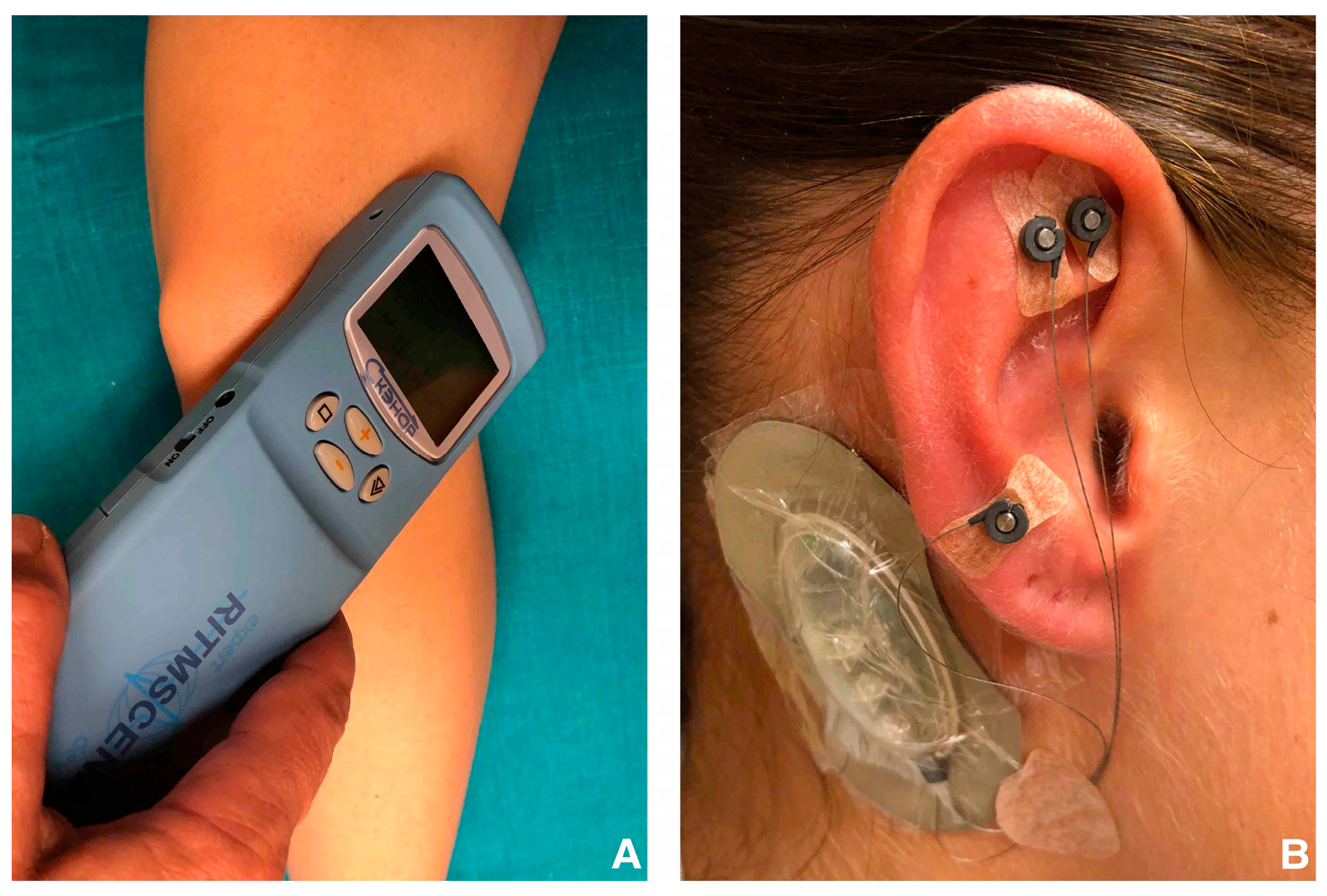 Using Electronic Stimulation with Acpuncture