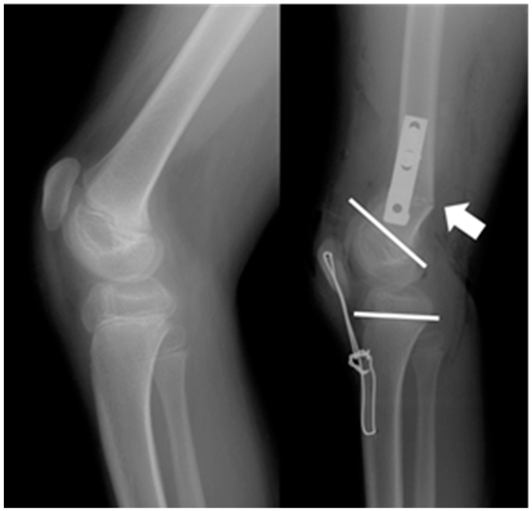 JCM Free FullText Distal Femoral Shortening Osteotomy for Severe