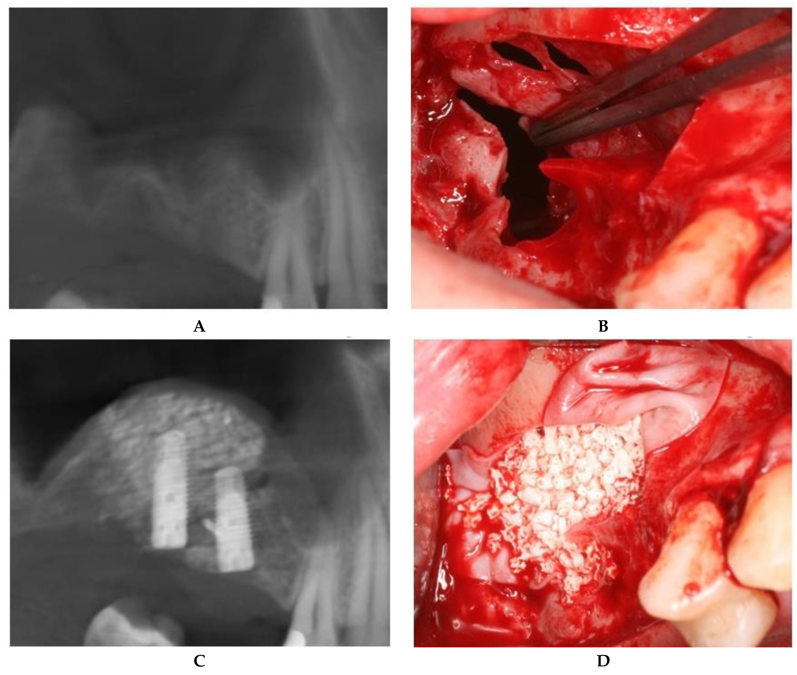 JCM | Free Full-Text | Management of Schneiderian Membrane Perforations  during Sinus Augmentation Procedures: A Preliminary Comparison of Two  Different Approaches | HTML