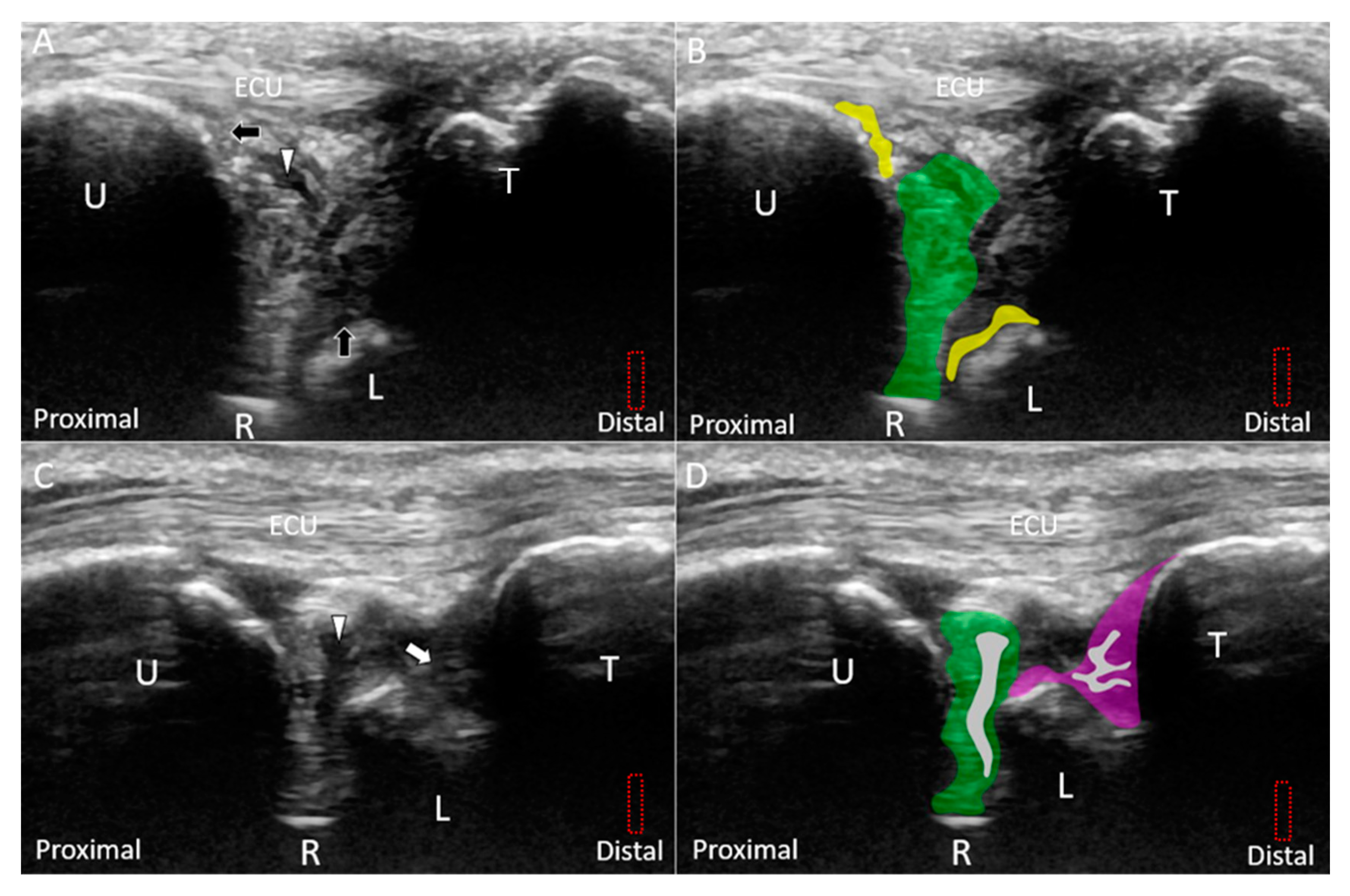 JCM | Free Full-Text | Ulnar Wrist Pain Revisited: Ultrasound Diagnosis