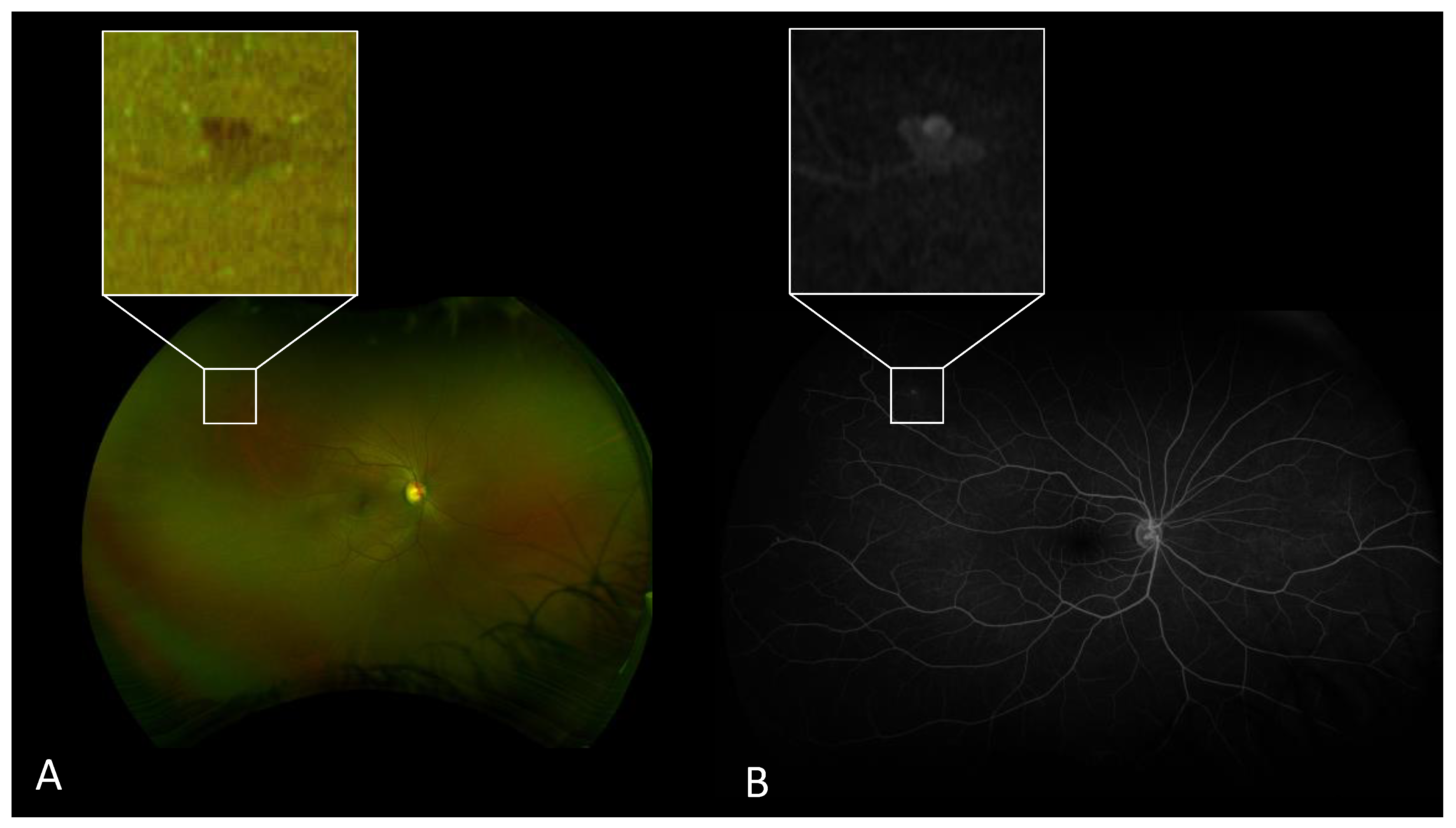 Jcm Free Full Text Sensitivity And Specificity Of Ultrawide Field Fundus Photography For The Staging Of Sickle Cell Retinopathy In Real Life Practice At Varying Expertise Level Html