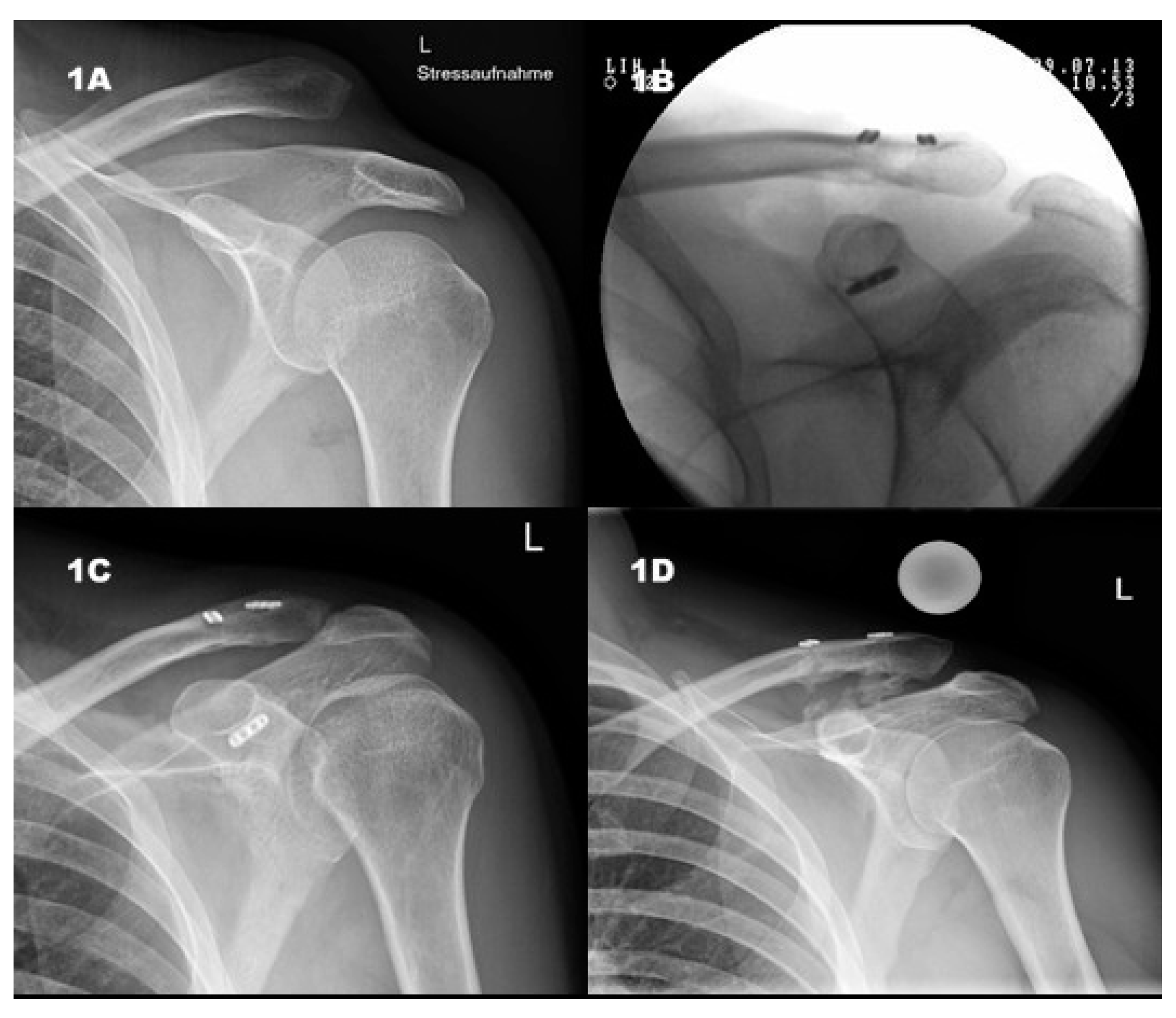 Delta technique reconstruction of a failed patellar tendon repair: a case  report