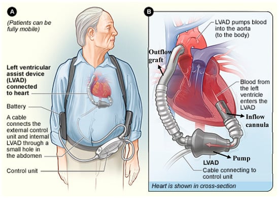 JCM | Free Full-Text | Left Ventricular Assist Devices 101: Shared Care ...