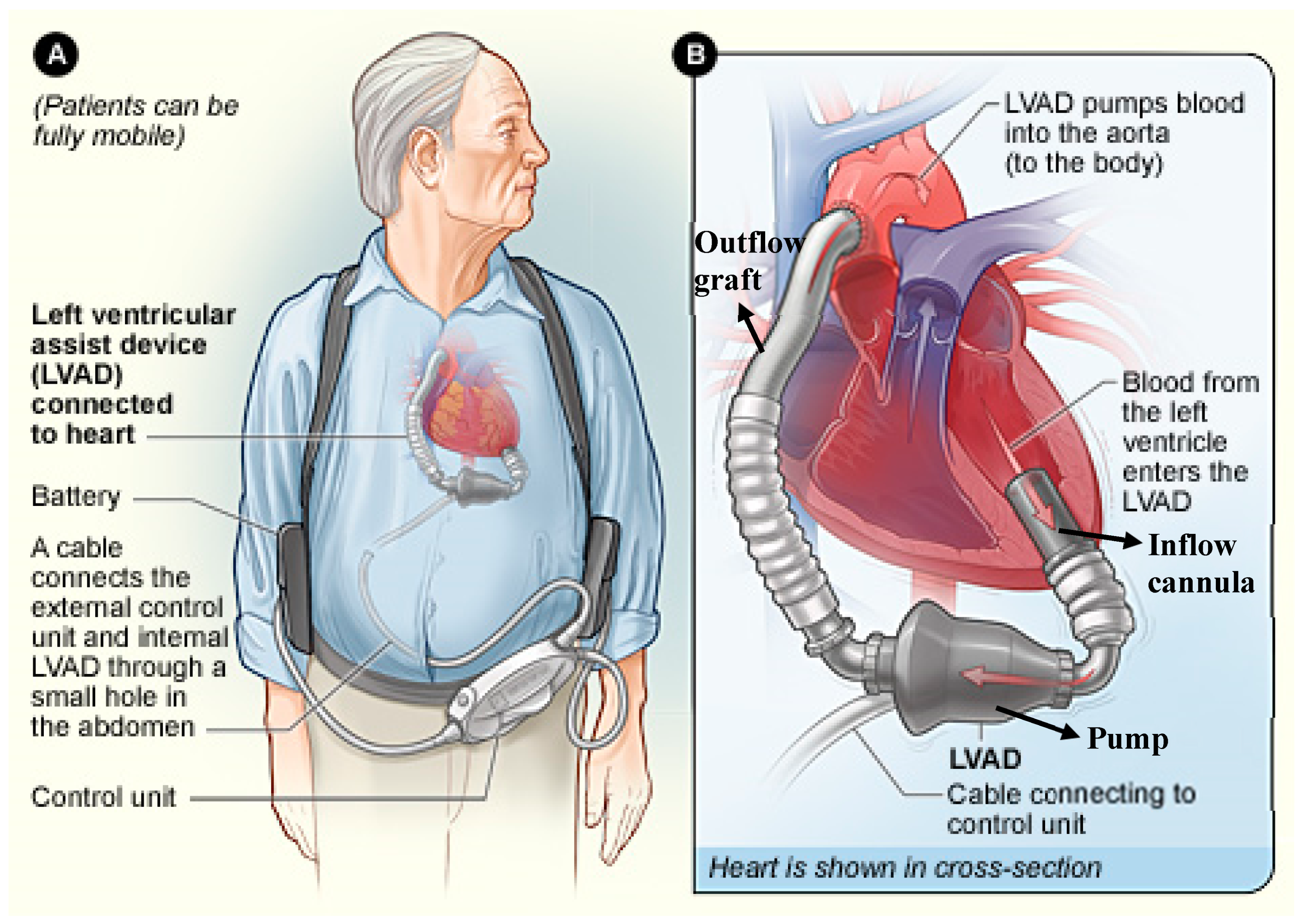 LVAD Back Pack, Water resistant, One Size Fits All