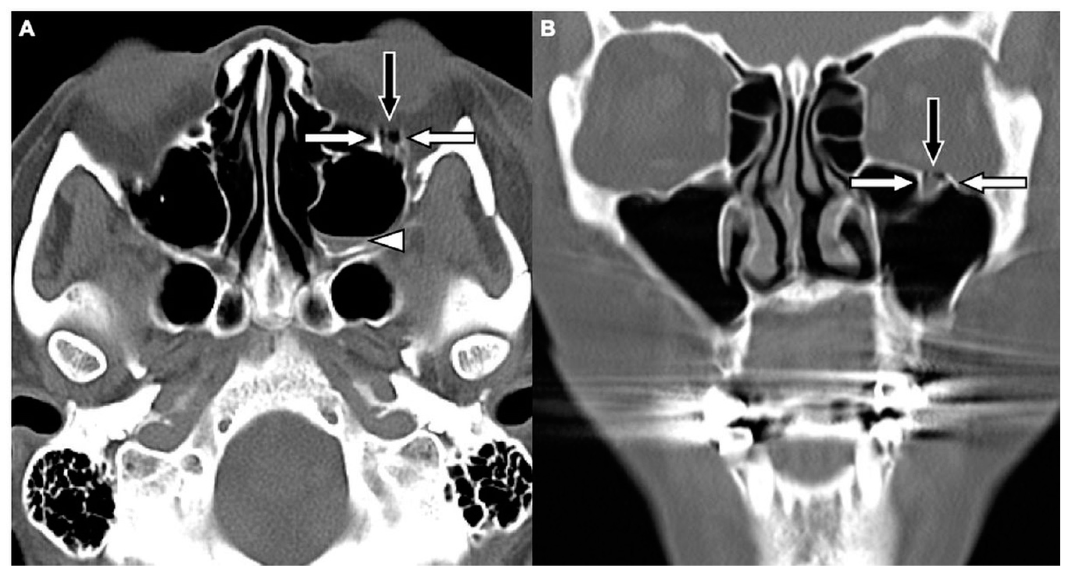 Jcm Free Full Text Evaluation Of Concomitant Orbital Floor