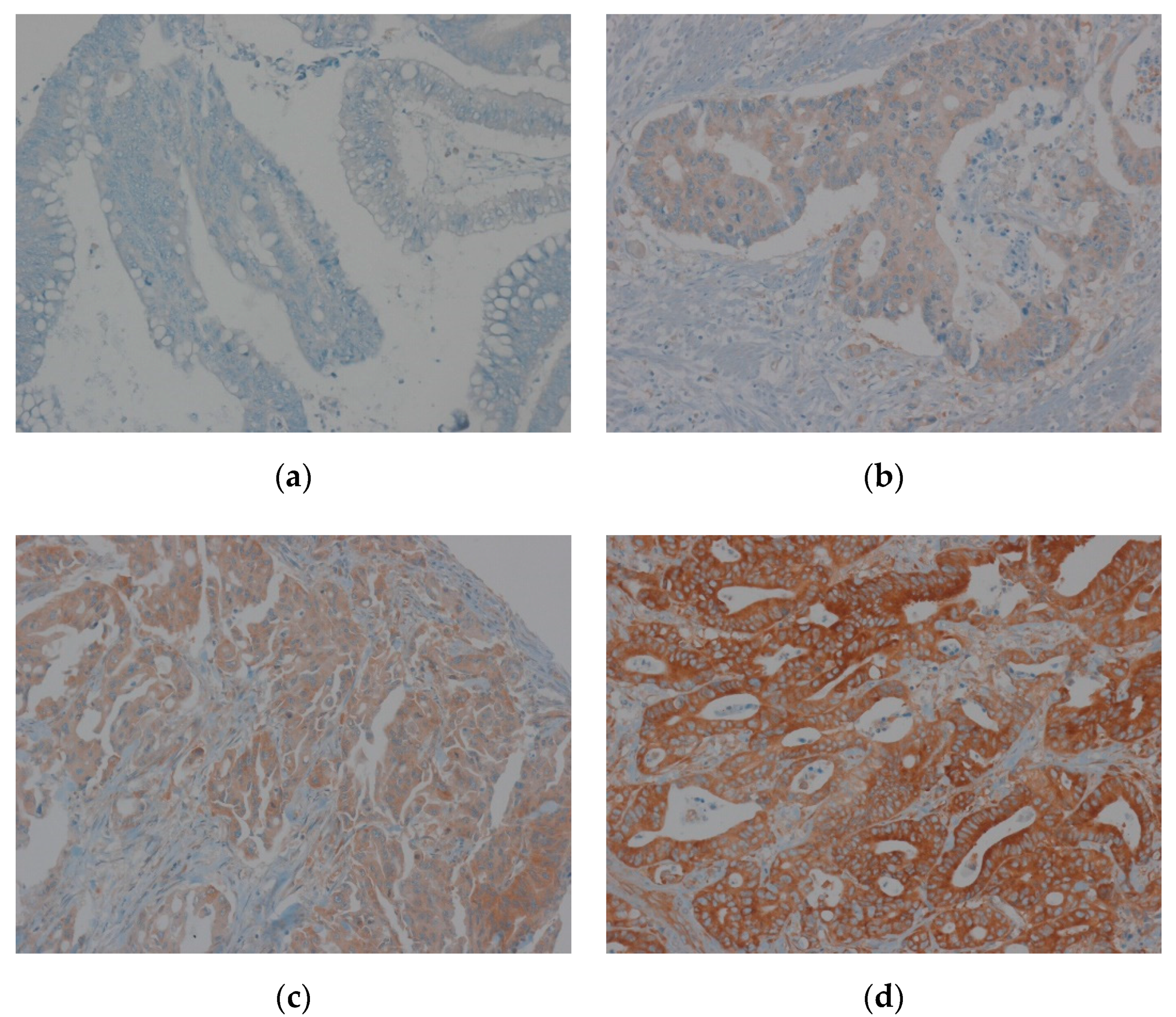 JCM | Free Full-Text | Expression of EEF1A1 Is Associated with Prognosis of  Patients with Colon Adenocarcinoma | HTML
