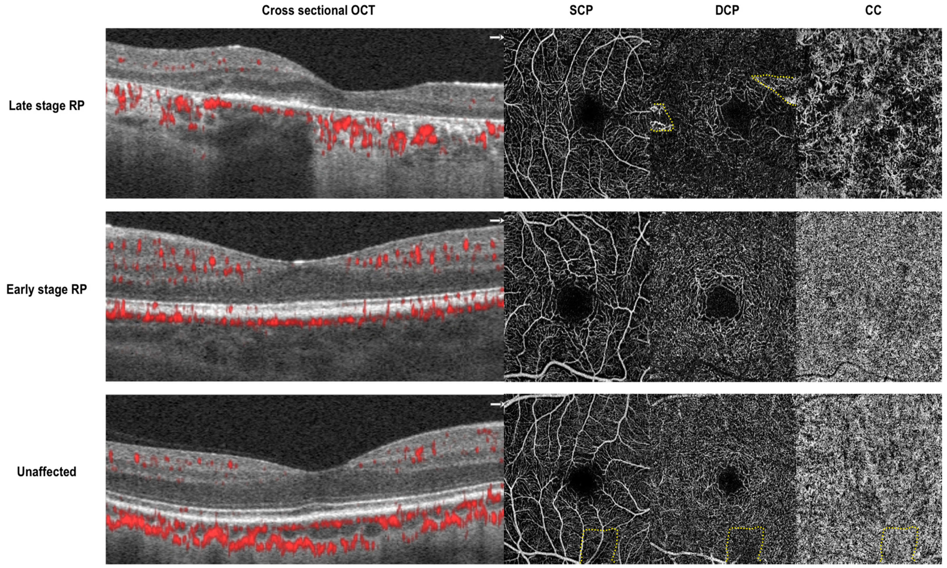 JCM | Free Full-Text | Optical Coherence Tomography Angiography Imaging in  Inherited Retinal Diseases