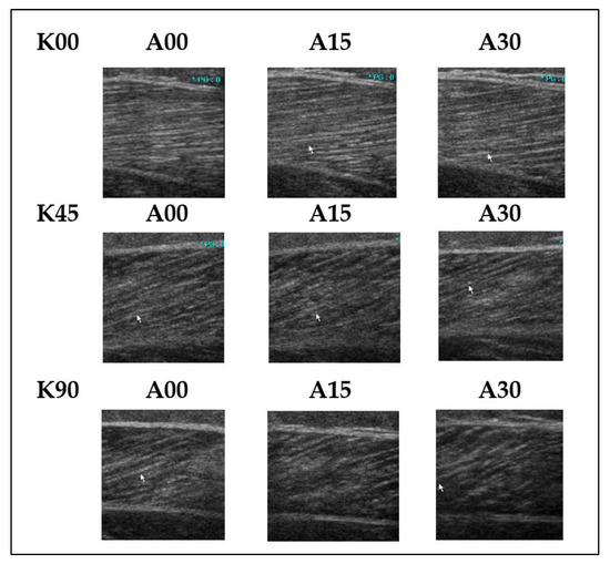 JCM | Free Full-Text | Architecture of the Triceps Surae Muscles Complex in  Patients with Spastic Hemiplegia: Implication for the Limited Utility of  the Silfverskiöld Test