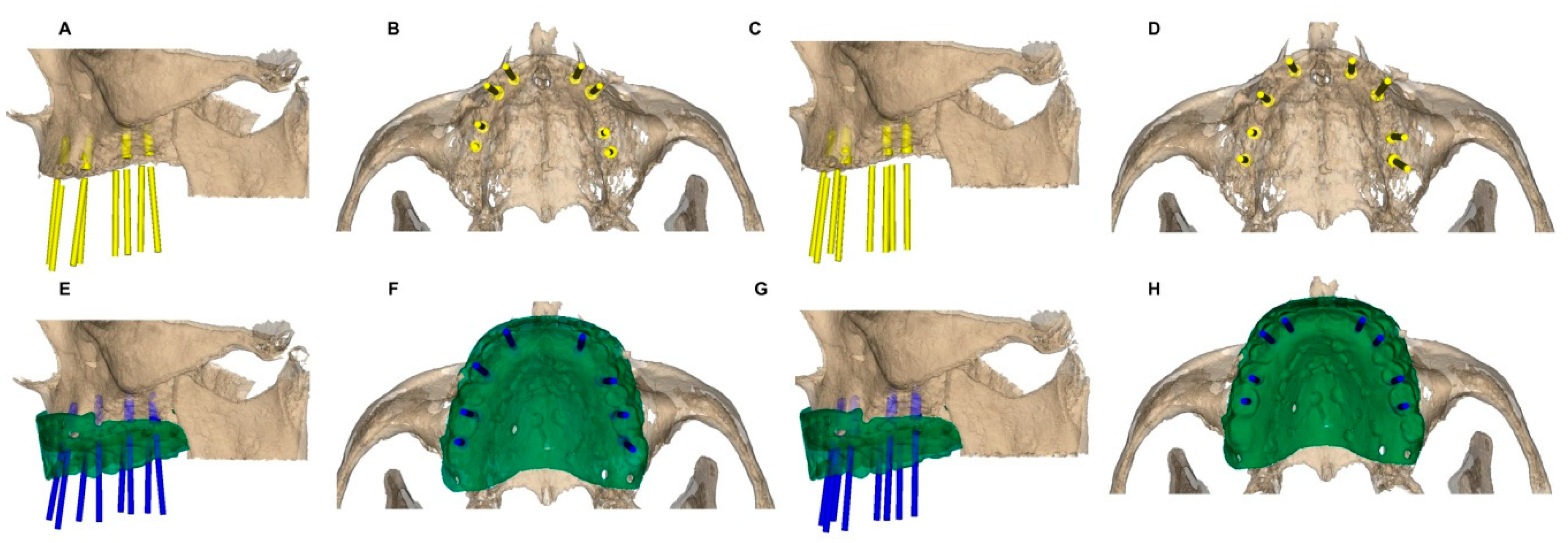 Jcm Free Full Text Influence Of The Digital Mock Up And Experience On The Ability To Determine The Prosthetically Correct Dental Implant Position During Digital Planning An In Vitro Study Html