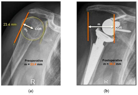 A trial product of the miniature X-ray tube experimentally produced by