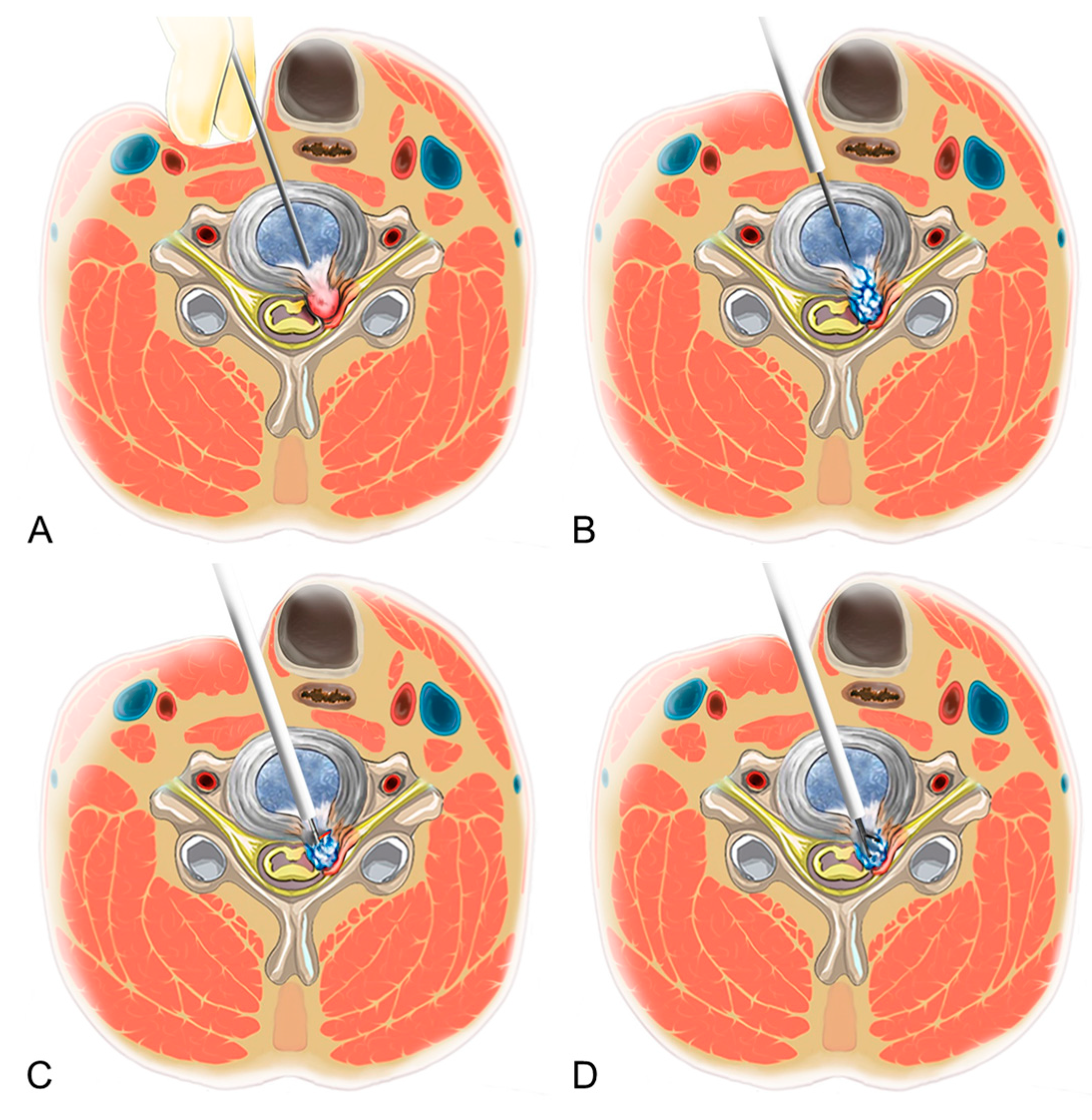 JCM | Free Full-Text | Percutaneous Endoscopic Cervical Discectomy versus  Anterior Cervical Discectomy and Fusion: A Comparative Cohort Study with a  Five-Year Follow-Up