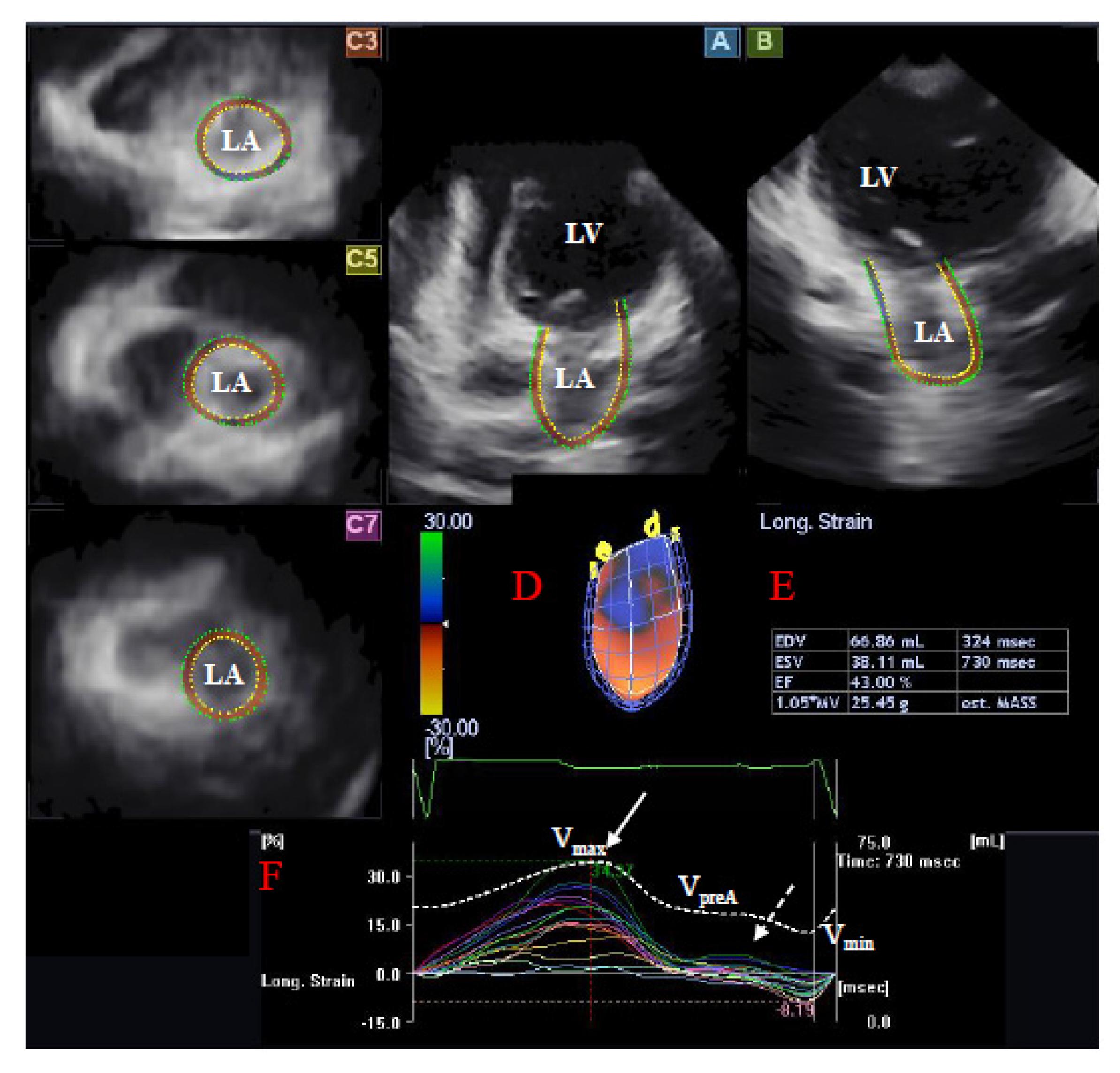JCM | Free Full-Text | Left Atrial Volumetric and Deformation Analysis in  Adult Patients with Dextro-Transposition of the Great Arteries (Insights  from the CSONGRAD Registry and MAGYAR-Path Study)