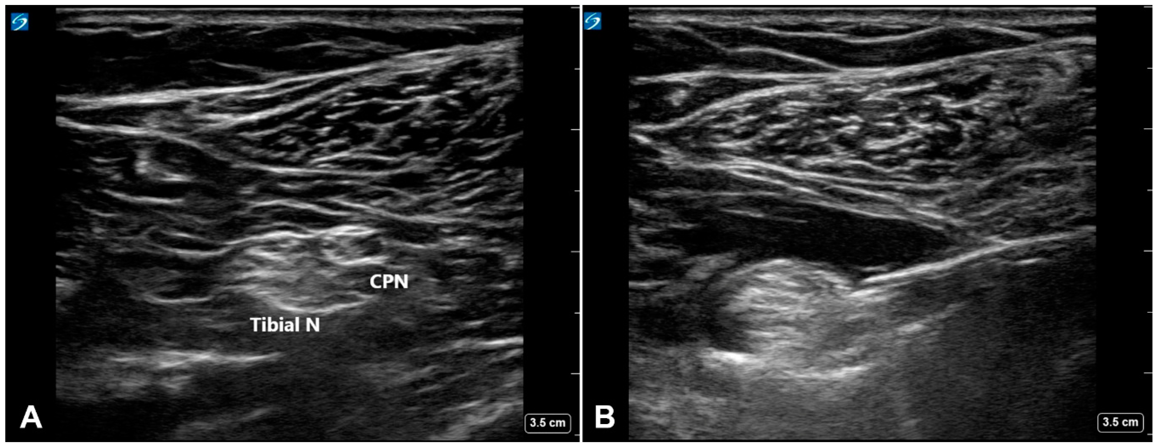 popliteal nerve block ultrasound