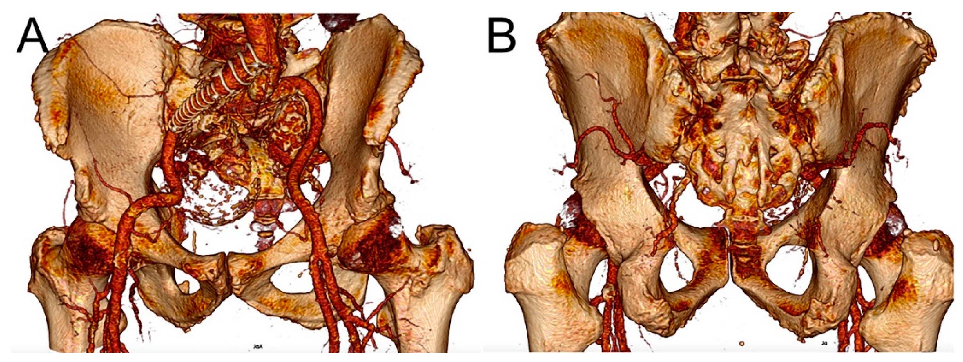 superior gluteal artery model