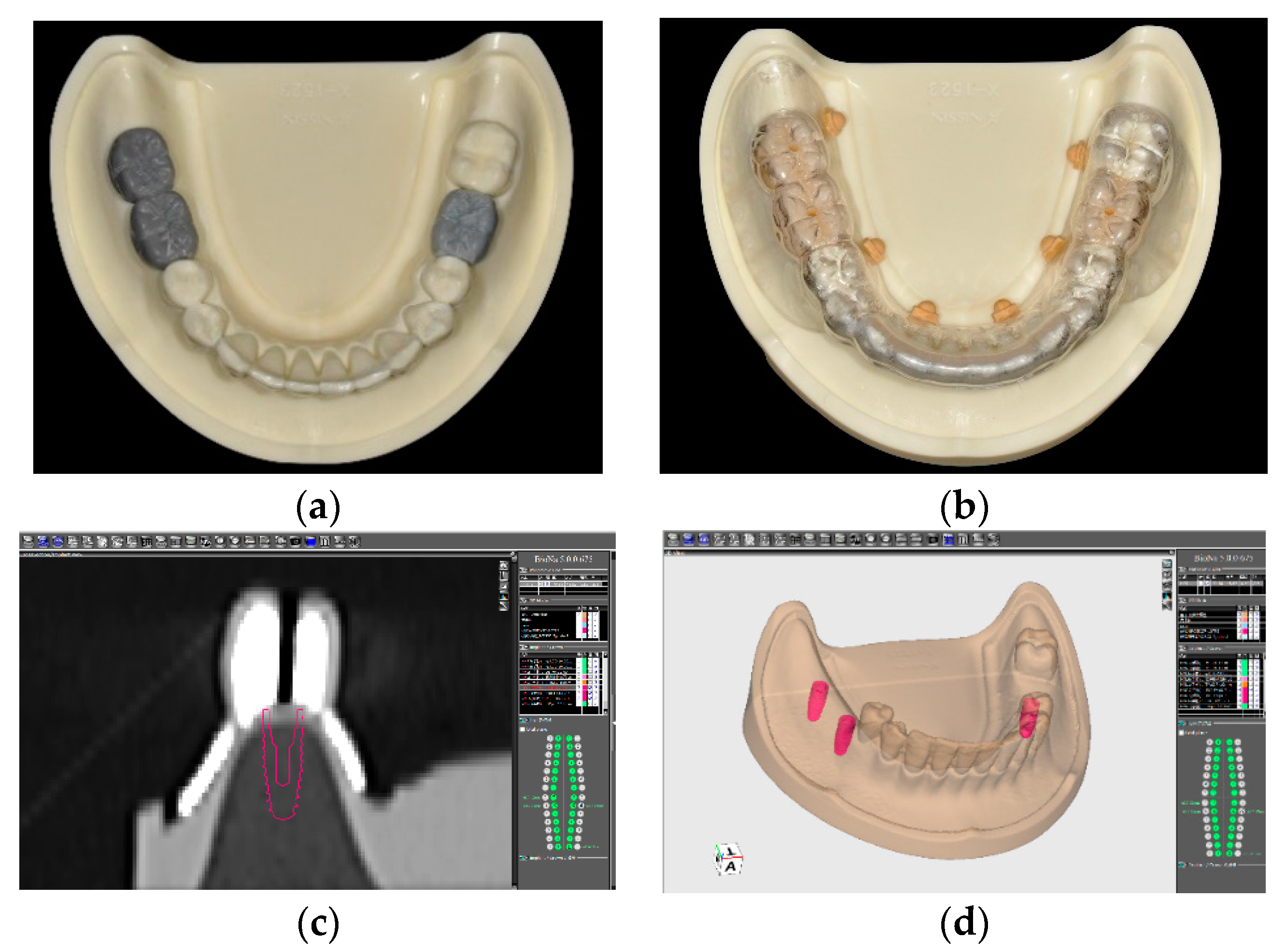 Surgical Guides for Implant Dentistry