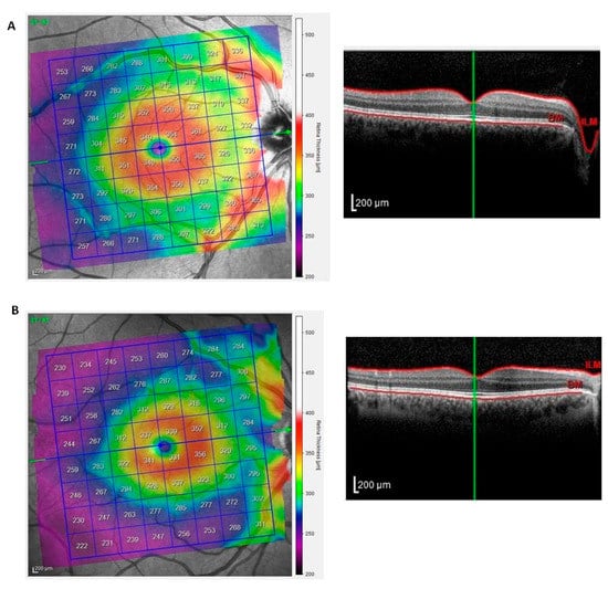 Retinal vascular assessment in psoriatic patients with and without  metabolic syndrome using optical coherence tomography angiography