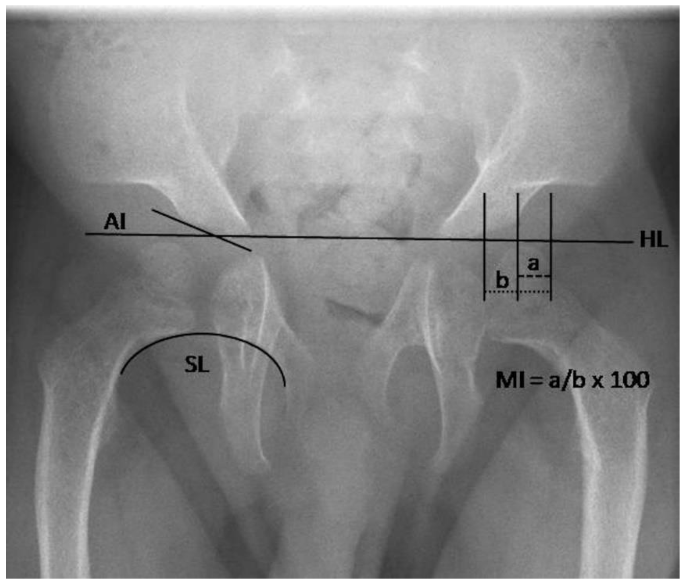 Hip fixation support dysplasia orthosis children's frog abduction