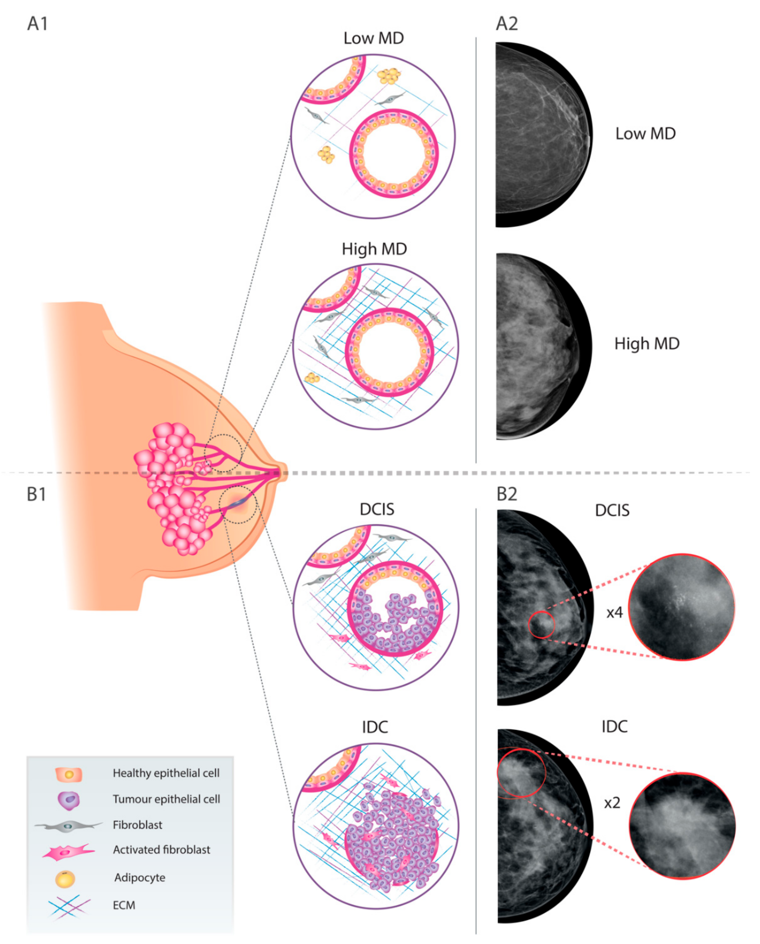 JCM | Free Full-Text | Breast Mammographic Density: Stromal Implications on  Breast Cancer Detection and Therapy