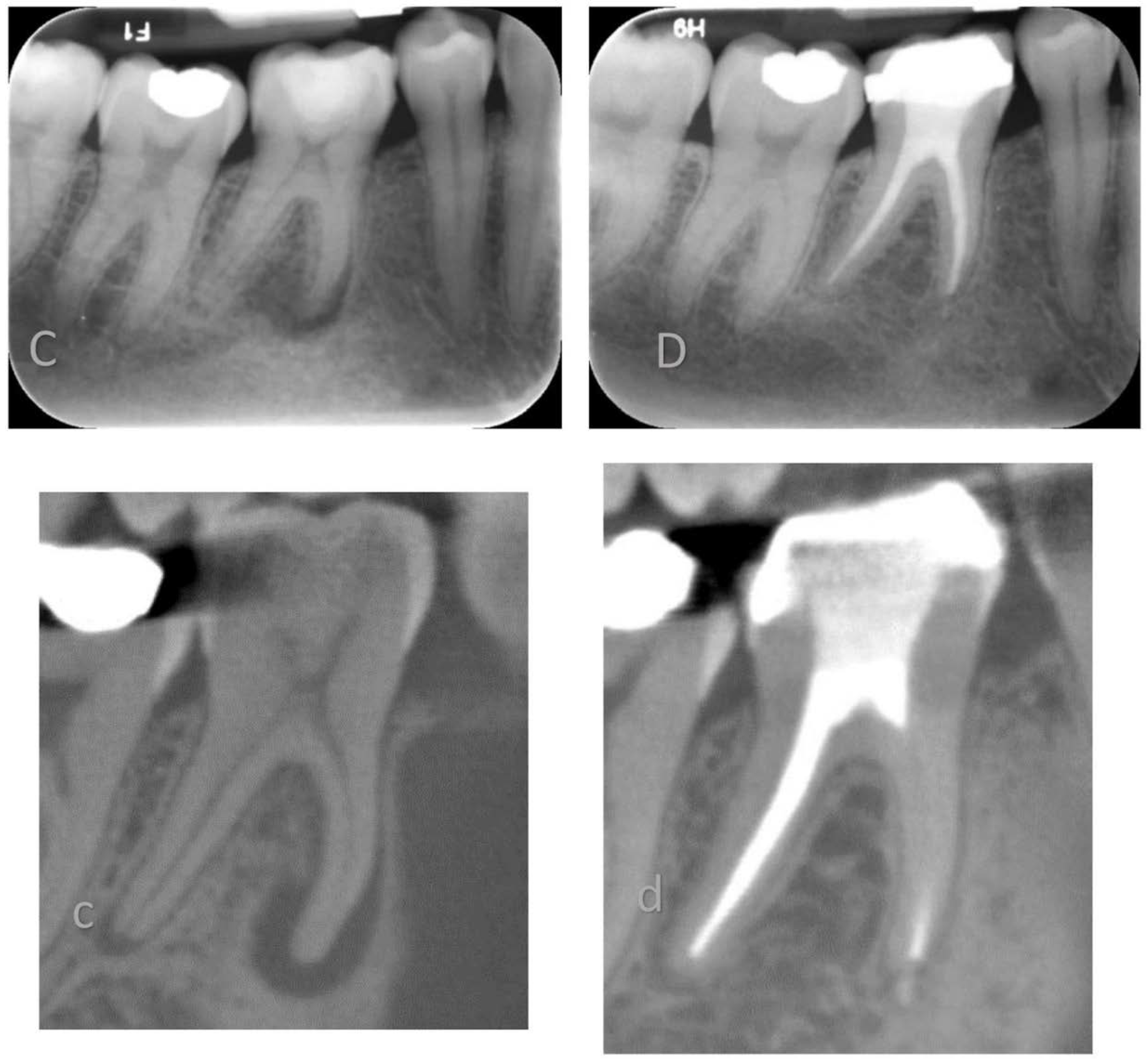 JCM | Free Full-Text | Outcome of Root Canal Treatments Using a 