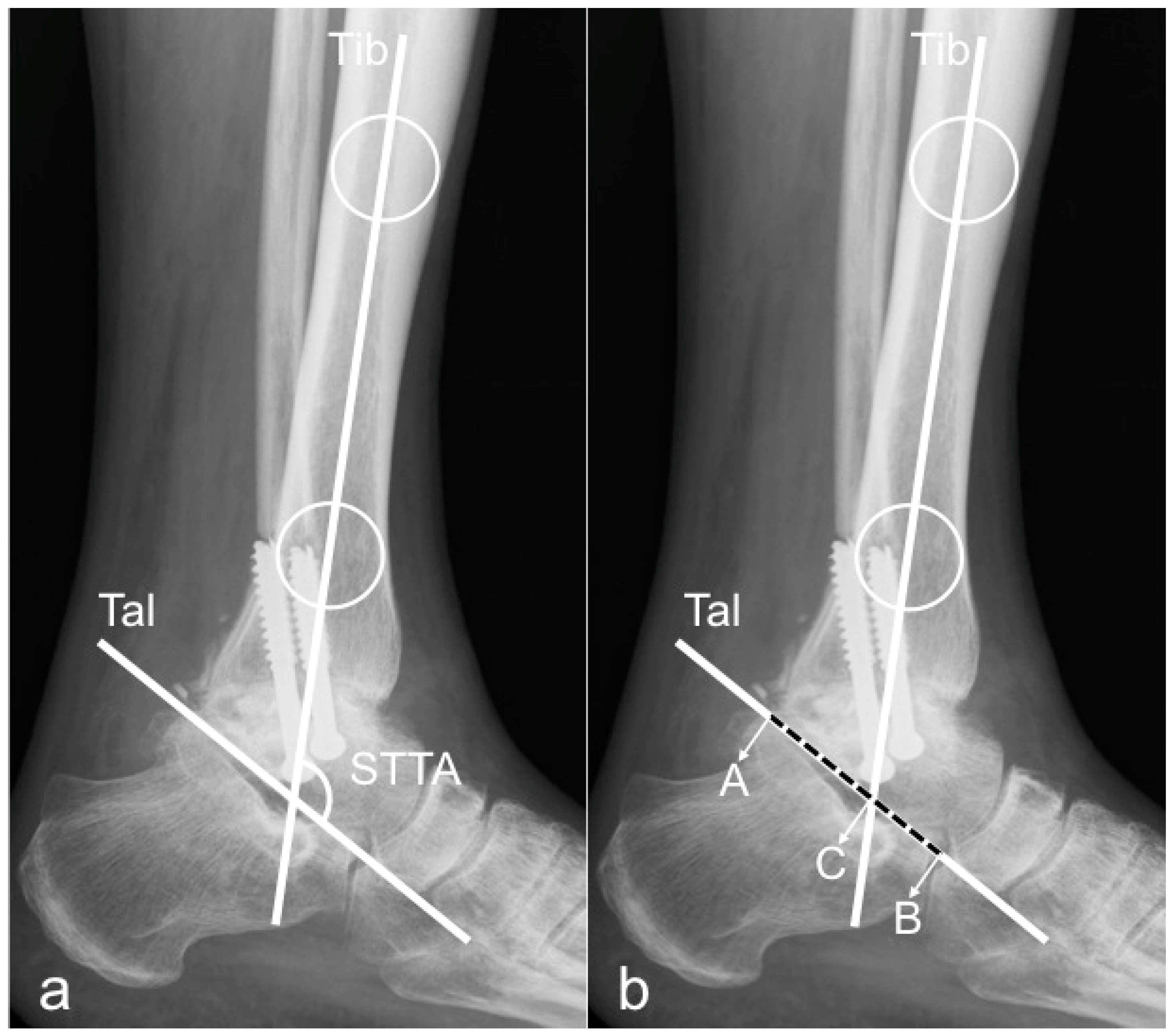 Ankle Fracture Treatment - Moore Foot & Ankle