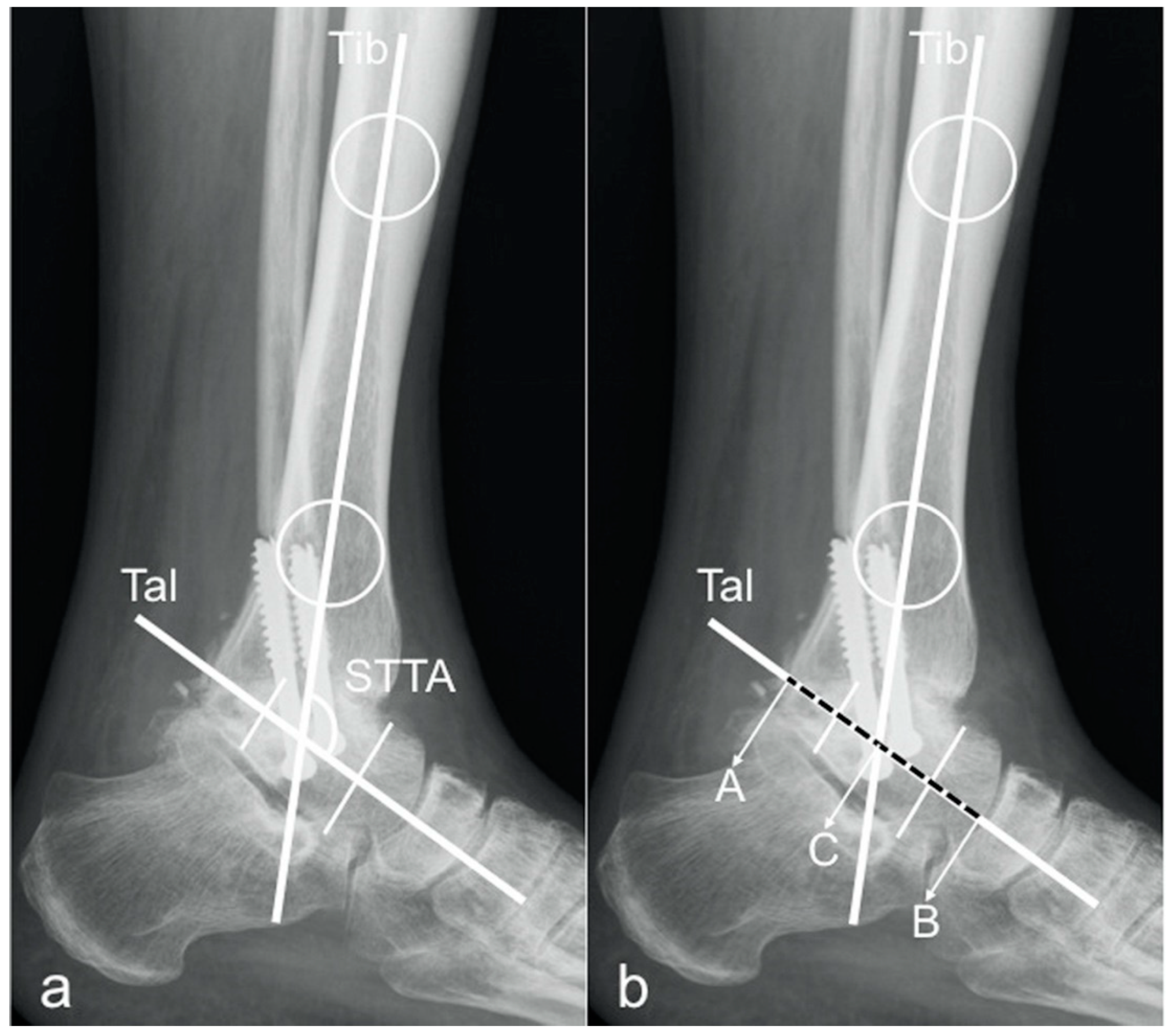 x ray hindfoot fusion