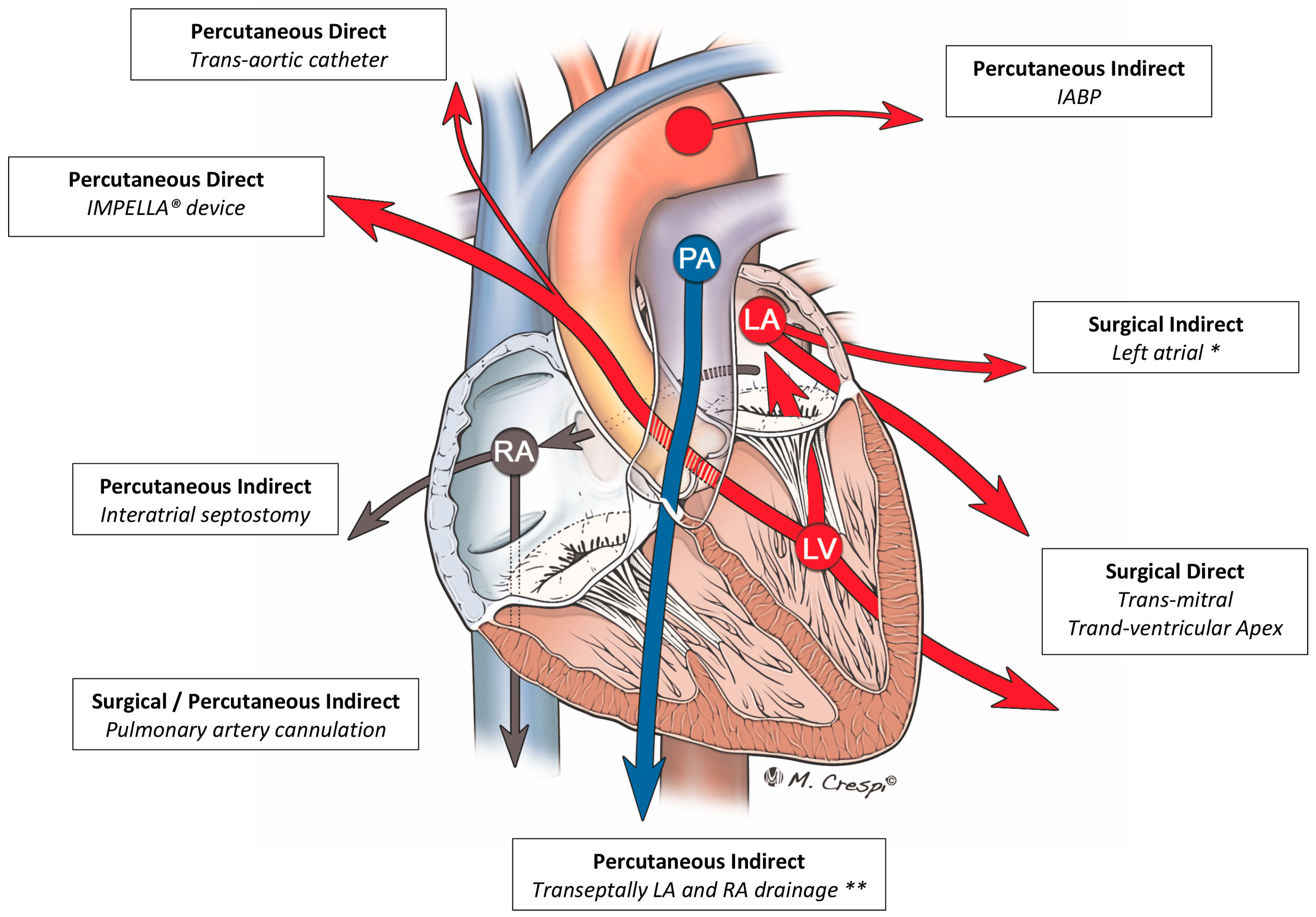 Direct surgical access to right femoral vessels for veno-arterial