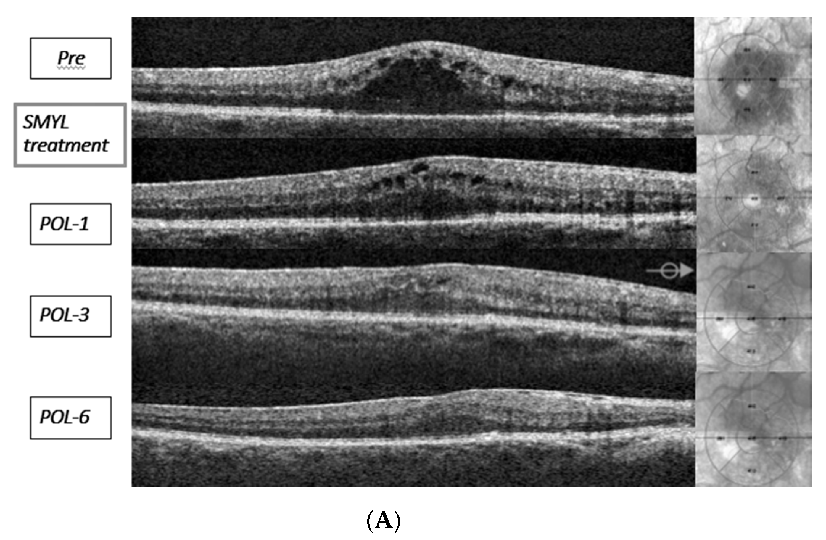 macular edema oct