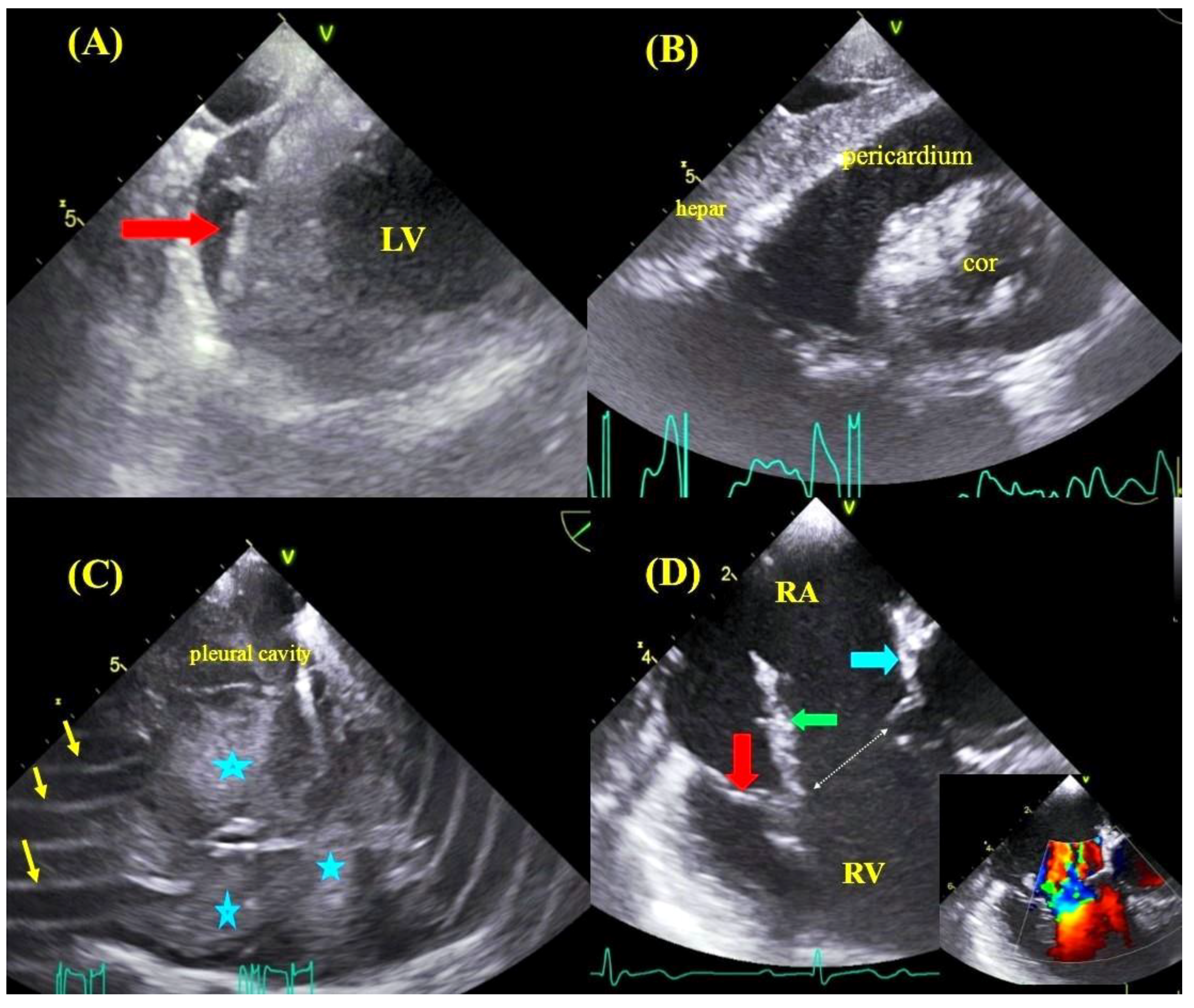 JCM | Free Full-Text | Transesophageal Echocardiography as a Monitoring  Tool during Transvenous Lead Extraction—Does It Improve Procedure  Effectiveness?