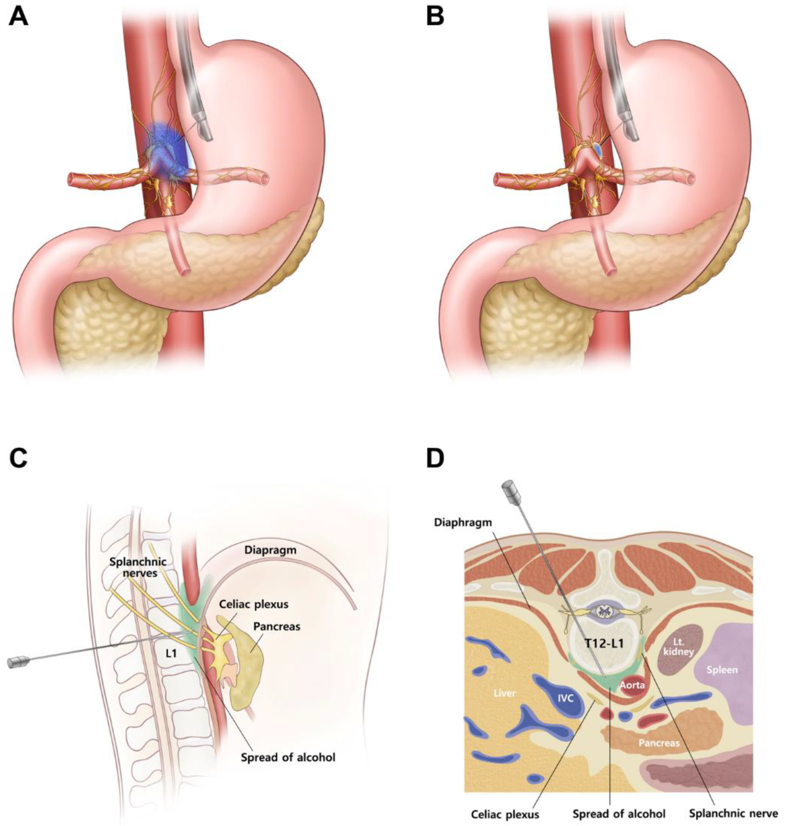 JCM | Free Full-Text | EUS-Guided Versus Percutaneous Celiac Neurolysis for  the Management of Intractable Pain Due to Unresectable Pancreatic Cancer: A  Randomized Clinical Trial