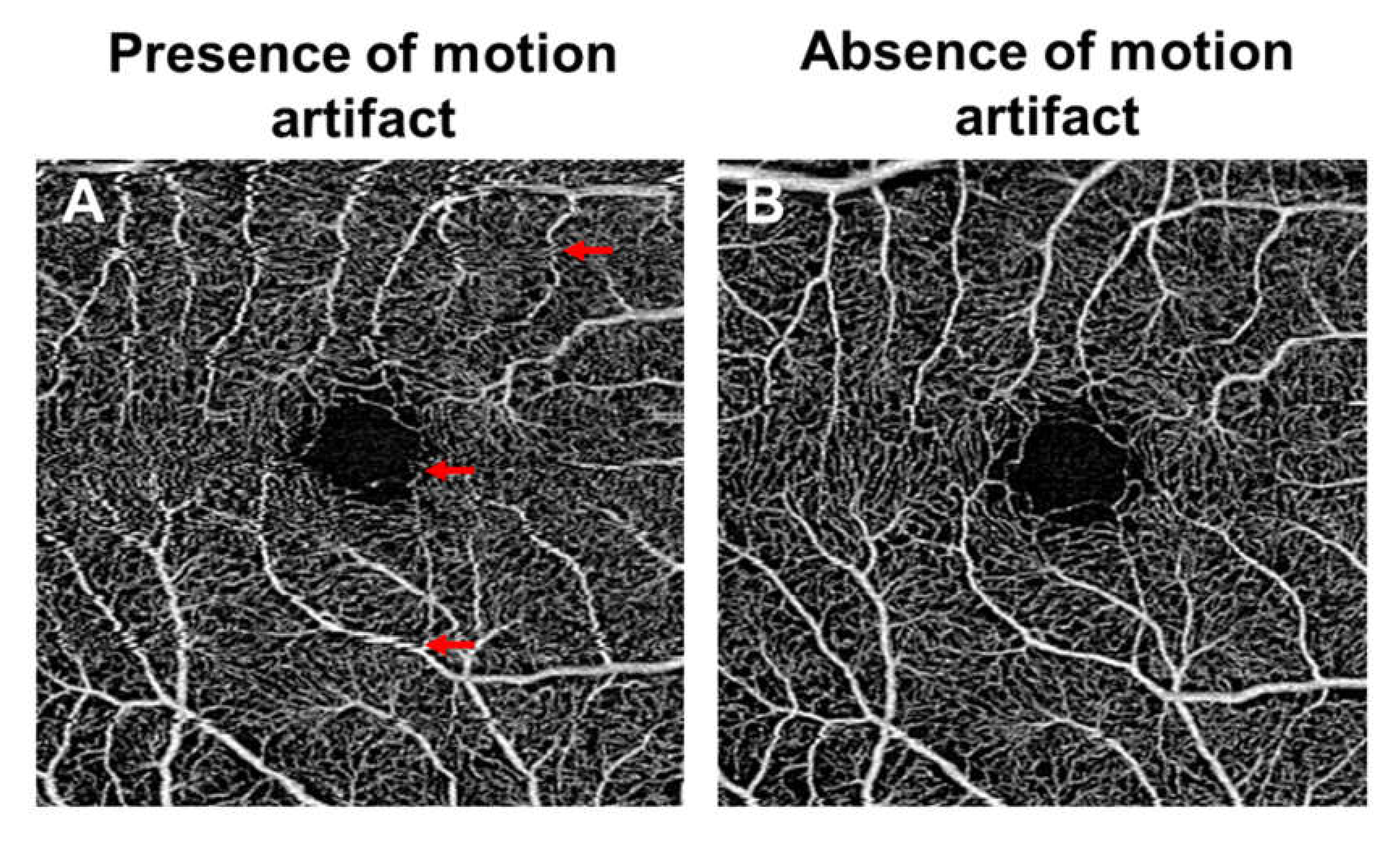 optical coherence tomography diabetic retinopathy